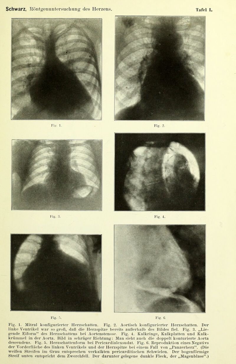 Fig. Fig. 6. Fig. 1. Mitral konfigurierter Ilerzseliatten. Fig. 2. Aortiscli konfigurierter Ilerzscliatten. Der linke Ventrikel war so groß, «laß die Herzspitze bereits außerhalb des Bildes fiel. Fig. 3. „Lie- gende Eiforin” des Herzsehattens bei Aortenstenose. Fig. 4. Kalkringe, Kalkplatten und Kalk- krüininel in der Aorta. Bild in schräger Richtung: Man sieht auch die «loppelt konturierte Aorta descendens. Fig. 5. Herzschattenforin bei Pericardialexsudat. Fig. 6. Reproduktion eines Negativs der Vorderfläche des linken Ventrikels und der Herzspitze bei einem Fall von ,,Panzerherz”. (Die weißen Streifen im Grau entsprechen verkalkten pericarditisehen Schwielen. Der bogenförmige Streif unten entspricht dem Zwerchfell. Der darunter gelegene dunkle Fleck, der „Magenblase”.)