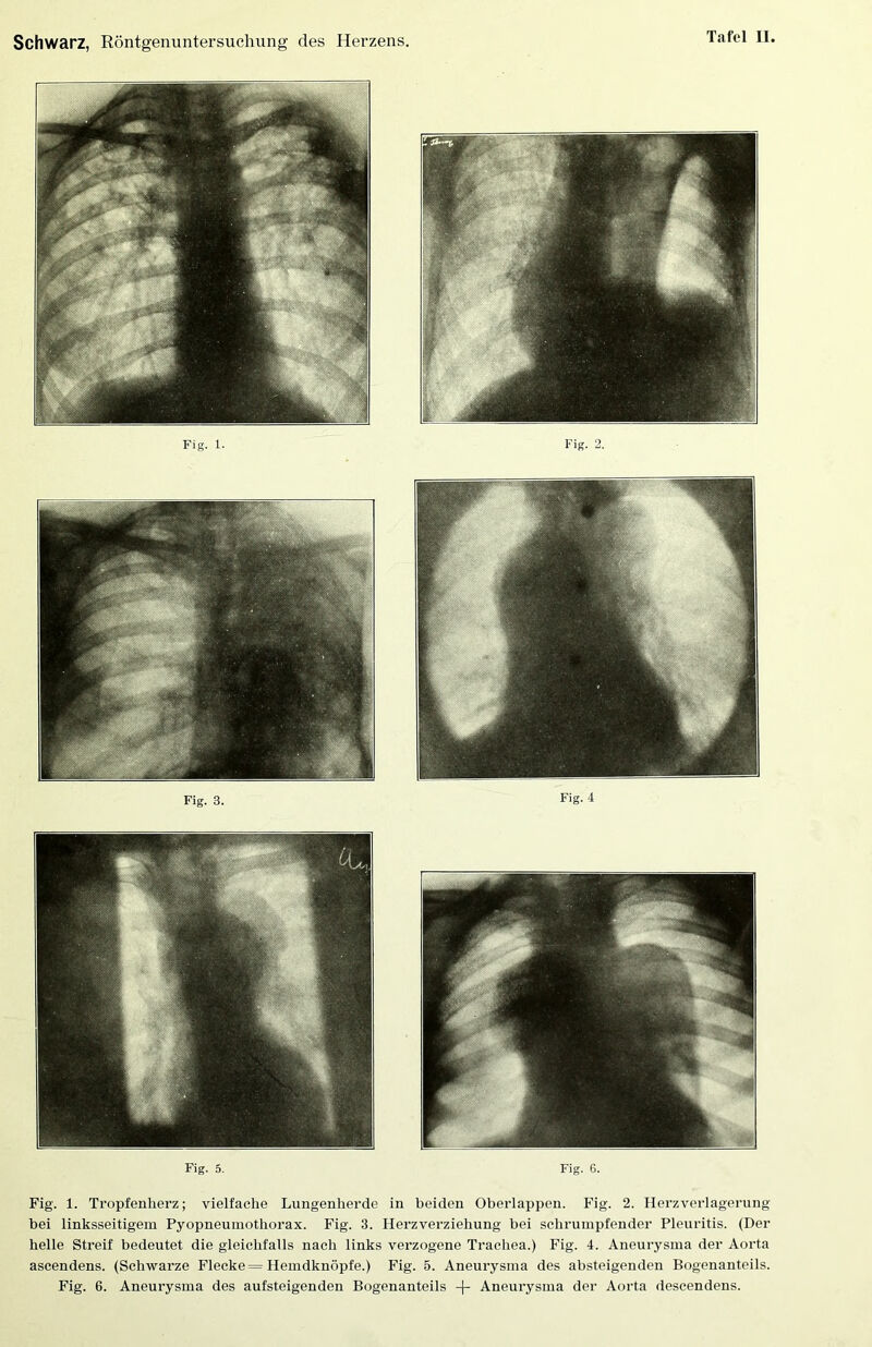 Fig. 1. Fig. 2. Fig. 3. Fig. 4 Fig. 6. Fig. 1. Tropfenherz; vielfache Lungenherde in beiden Oberlappen. Fig. 2. Ilerzverlagernng bei linksseitigem Pyopneuniothorax. Fig. 3. Herzverziehung bei schrumpfender Pleuritis. (Der helle Streif bedeutet die gleichfalls nach links verzogene Trachea.) Fig. 4. Aneurysma der Aorta ascendens. (Schwarze Flecke = Hemdknöpfe.) Fig. 5. Aneurysma des absteigenden Bogenanteils. Fig. 6. Aneurysma des aufsteigenden Bogenanteils -f- Aneurysma der Aorta descendens.