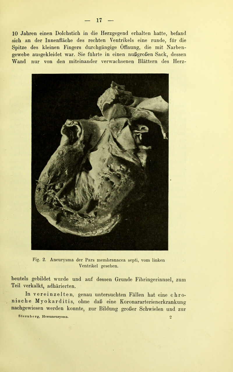 10 Jahren einen Dolchstich in die Herzgegend erhalten hatte, befand sich an der Innenfläche des rechten Ventrikels eine runde, für die Spitze des kleinen Fingers durchgängige Öffnung, die mit Narben- gewebe ausgekleidet war. Sie führte in einen nußgroßen Sack, dessen Wand nur von den miteinander verwachsenen Blättern des Herz- Fig. 2. Aneurysma der Pars membranacea septi, vom linken Ventrikel gesehen. beutels gebildet wurde und auf dessen Grunde Fibringerinnsel, zum Teil verkalkt, adhärierten. In vereinzelten, genau untersuchten Fällen hat eine chro- nische Myokarditis, ohne daß eine Koronararterienerkrankung nachgewiesen werden konnte, zur Bildung großer Schwielen und zur Sternberg, Herzaneurysma. 2