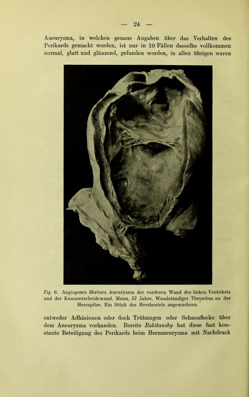 Aneurysma, in welchen genaue Angaben über das Verhalten des Perikards gemacht werden, ist nur in 10 Fällen dasselbe vollkommen normal, glatt und glänzend, gefunden worden, in allen übrigen waren Fig. 6. Angiogenes fibröses Aneurysma der vorderen Wand des linken Ventrikels und der Kammerscheidewand. Mann, 57 Jahre. Wandständiger Thrombus an der Herzspitze. Ein Stück des Herzbeutels angewachsen. entweder Adhäsionen oder doch Trübungen oder Sebnenflecke über dem Aneurysma vorhanden. Bereits Rokitansky bat diese fast kon- stante Beteiligung des Perikards beim Herzaneurysma mit Nachdruck