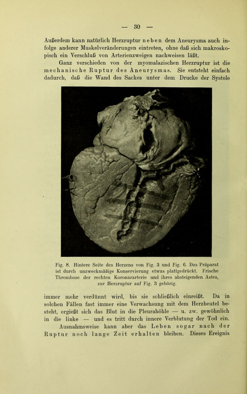 Außerdem kann natürlich Herzruptur neben dem Aneurysma auch in- folge anderer Muskelveränderungen eintreten, ohne daß sich makrosko- pisch ein Verschluß von Arterienzweigen nachweisen läßt. Ganz verschieden von der myomalazischen Herzruptur ist die mechanische Ruptur des Aneurysmas. Sie entsteht einfach dadurch, daß die Wand des Sackes unter dem Drucke der Systole Fig. 8. Hintere Seite des Herzens von Fig. 3 und Fig. 6. Das Präparat ist durch unzweckmäßige Konservierung etwas plattgedrückt. Frische Thrombose der rechten Koronararterie imd ihres absteigenden Astes, zur Herzruptur auf Fig. 3 gehörig. immer mehr verdünnt wird, bis sie schließlich einreißt. Da in solchen Fällen fast immer eine Verwachsung mit dem Herzbeutel be- steht, ergießt sich das Blut in die Pleurahöhle — u. zw. gewöhnlich in die linke — und es tritt durch innere Verblutung der Tod ein. Ausnahmsweise kann aber das Leben sogar nach der Ruptur noch lange Zeit erhalten bleiben. Dieses Ereignis