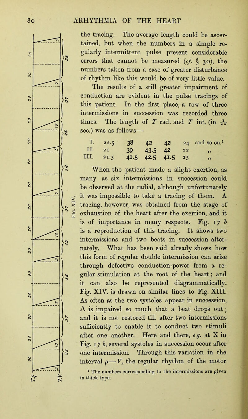 T.V. the tracing. The average length could be ascer- tained, but when the numbers in a simple re- gularly intermittent pulse present considerable errors that cannot be measured (cf. § 30), the numbers taken from a case of greater disturbance of rhythm like this would be of very little value. The results of a still greater impairment of conduction are evident in the pulse tracings of this patient. In the first place, a row of three intermissions in succession was recorded three times. The length of T rad. and T int. (in -it sec.) was as follows— I. II. III. 22.5 38 42 42 24 21 39 43-5 42 22 21-5 4i-5 42.5 4i-5 25 When the patient made a slight exertion, as many as six intermissions in succession could be observed at the radial, although unfortunately it was impossible to take a tracing of them. A tracing, however, was obtained from the stage of exhaustion of the heart after the exertion, and it is of importance in many respects. Fig. 17 b is a reproduction of this tracing. It shows two intermissions and two beats in succession alter- nately. What has been said already shows how this form of regular double intermission can arise through defective conduction-power from a re- gular stimulation at the root of the heart; and it can also be represented diagrammatically. Fig. XIY. is drawn on similar lines to Fig. XIII. As often as the two systoles appear in succession, A is impaired so much that a beat drops out; and it is not restored till after two intermissions sufficiently to enable it to conduct two stimuli after one another. Here and there, e.g. at X in Fig. 1J b, several systoles in succession occur after one intermission. Through this variation in the interval p— Vs the regular rhythm of the motor in thick type.