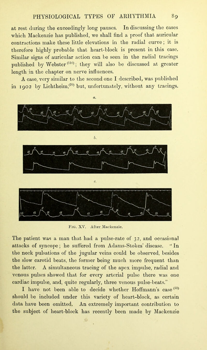 at rest during the exceedingly long pauses. In discussing the cases which Mackenzie has published, we shall find a proof that auricular contractions make these little elevations in the radial curve; it is therefore highly probable that heart-block is present in this case. Similar signs of auricular action can be seen in the radial tracings published by Webster(llb); they will also be discussed at greater length in the chapter on nerve influences. A case, very similar to the second one I described, was published in 1902 by Lichtheim,(70) but, unfortunately, without any tracings. b. Fig. XV. After Mackenzie. The patient was a man that had a pulse-rate of 32, and occasional attacks of syncope; he suffered from Adams-Stokes’ disease. “ In the neck pulsations of the jugular veins could be observed, besides the slow carotid beats, the former being much more frequent than the latter. A simultaneous tracing of the apex impulse, radial and venous pulses showed that for every arterial pulse there was one cardiac impulse, and, quite regularly, three venous pulse-beats.” I have not been able to decide whether Hoffmann’s case(53) should be included under this variety of heart-block, as certain data have been omitted. An extremely important contribution to the subject of heart-block has recently been made by Mackenzie