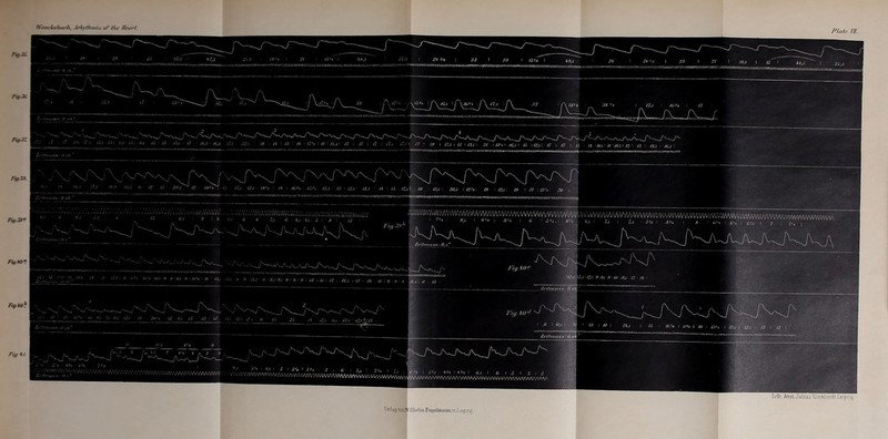 /yjs FrgA Fiq .77 F&Xt F<g.z>° Fig.*0« Fig M)\ FiH */ Wenckebach. Arrhythmia of the Heart. Plate YIL. Y»YYWYY»Y< WT>WVVV\VWV\$ WYYWVVY*  rn ^ r ' 19 I 17.5 I 13 * 13.5 i 21 \13'«\ 10,5 I 15 \12,s I 17 \ 17 \ n /t, ^mimmwnfflninnninnMnwnYhriTpMfflwwwvmmnmwnm^^ 13.5 l/i : /.3 >/“jj /.V JCU I 12'. h 19 KU\ 19 I />* i 129, 20 ! ivoirn^nwnrnTiyfflViTTnwmfTrr.rrTTffiT'T^^yT^fWiTfffrfiTrOT^ ........ I. J*M/U/ AM ... .'.’I .Vi/J JV\.'y\/1VJ\iVV/w'vV /WiMWffiVWWWWWWWWWWWV^^ r:„v,,il ■ ^ ! 1 *'* 1 ff ’ «'♦ 7-' 1 -13 ’ 1 •» 1 I 7 ; 7'.. | ,J: /'VV/.'/() ! .// ! 10,5 I .>©( I 13 \ 10 Zeiimaas 0, oo  TZ H .V//.. . V.VMVvWvVVWWV V. . I 4WIW.A.VAWtM WVyWTWVWWWWWVWWVVVWWWVWV^ A AA aa n n aa An Lith. Aust.Julius Klinkhardt Leipzig Yerlag vouYilliel lm Encjehiiainiin Leipzig