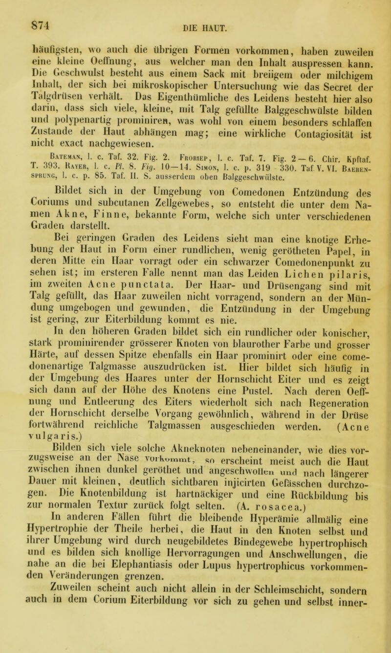 häufigsten, wo auch die übrigen Formen Vorkommen, haben zuweilen eine kleine Oeflnung, aus welcher man den Inhalt auspressen kann. Die Geschwulst besteht aus einem Sack mit breiigem oder milchigem Inhalt, der sich bei mikroskopischer Untersuchung wie das Secret der Talgdrüsen verhält. Das Eigentümliche des Leidens besteht hier also darin, dass sich viele, kleine, mit Talg gefüllte Balggeschwülste bilden und polypenartig prominiren, was wohl von einem besonders schlaffen Zustande der Haut abhängen mag; eine wirkliche Contagiosität ist nicht exact nachgewiesen. Bateman, 1. c. Taf. 32. Fig. 2. Froriep, I. c. Taf. 7. Fig. 2 — 6. Chir. Kpftaf T. 393. Bayer, 1. c. PI. 8. Fig. 10—14. Simon, I. c. p. 319 330. Taf V. VI. Baeren- sprü.ng, I. c. p. 85. Taf. II. S. ausserdem oben Balggeschwiilstc. Bildet sich in der Umgebung von Comedonen Entzündung des Coriums und subcutanen Zellgewebes, so entsteht die unter dem Na- men Akne, Finne, bekannte Form, welche sich unter verschiedenen Graden darstellt. Bei geringen Graden des Leidens siebt man eine knotige Erhe- bung der Haut in Form einer rundlichen, wenig gerotheten Papel, in deren Mitte ein Haar vorragt oder ein schwarzer Comedonenpunkt zu sehen ist; im ersteren Falle nennt man das Leiden Lichen pilaris, im zweiten Acne punctata. Der Haar- und Drüsengang sind mit Talg gefüllt, das Haar zuweilen nicht vorragend, sondern an der Mün- dung umgebogen und gewunden, die Entzündung in der Umgebung ist gering, zur Eiterbildung kommt es nie. In den höheren Graden bildet sich ein rundlicher oder konischer, stark prominirender grösserer Knoten von blaurother Farbe und grosser Härte, auf dessen Spitze ebenfalls ein Haar prominirt oder eine come- donenartige Talgmasse auszudrücken ist. Hier bildet sich häufig in der Umgebung des Haares unter der Hornschicht Eiter und es zeigt sich dann auf der Höbe des Knotens eine Pustel. Nach deren Oefl- nung und Entleerung des Eiters wiederholt sich nach Regeneration der Hornschicht derselbe Vorgang gewöhnlich, während in der Drüse fortwährend reichliche Talgmassen ausgeschieden werden. (Acne vulga ris.) Bilden sich viele solche Akneknoten nebeneinander, wie dies vor- zugsweise an der Nase vorkommt, so erscheint meist auch die Haut zwischen ihnen dunkel geröthet und angeschwollen und „ach längerer Dauer mit kleinen, deutlich sichtbaren injicirten Gefässchen durchzo- gen. Die Knotenbildung ist hartnäckiger und eine Rückbildung bis zur normalen Textur zurück folgt selten. (A. rosacea.) In anderen Fällen führt die bleibende Hyperämie allmälig eine Hypertrophie der Theile herbei, die Haut in den Knoten selbst und ihrer Umgebung wird durch neugebildetes Bindegewebe hypertrophisch und es bilden sich knollige Hervorragungen und Anschwellungen, die nahe an die bei Elephantiasis oder Lupus hypertrophicus vorkommen- den Veränderungen grenzen. Zuweilen scheint auch nicht allein in der Schleimschicht, sondern auch in dem Corium Eiterbildung vor sich zu gehen und selbst inner-