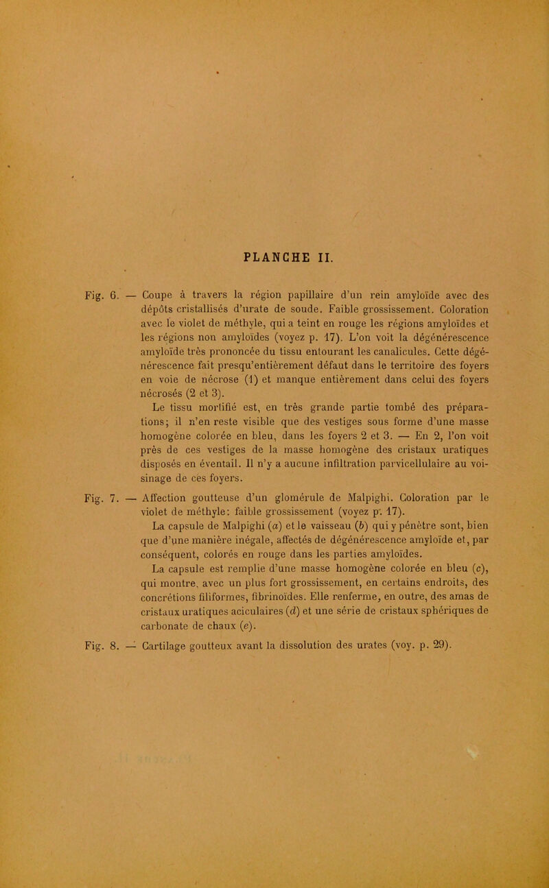 Fig. 6. — Coupe à travers la région papillaire d’un rein amyloïde avec des dépôts cristallisés d’urate de soude. Faible grossissement. Coloration avec le violet de méthyle, qui a teint en rouge les régions amyloïdes et les régions non amyloïdes (voyez p. 17). L’on voit la dégénérescence amyloïde très prononcée du tissu entourant les canalicules. Cette dégé- nérescence fait presqu’entièrement défaut dans le territoire des foyers en voie de nécrose (1) et manque entièrement dans celui des foyers nécrosés (2 et 3). Le tissu mortifié est, en très grande partie tombé des prépara- tions; il n’en reste visible que des vestiges sous forme d’une masse homogène colorée en bleu, dans les foyers 2 et 3. — En 2, l’on voit près de ces vestiges de la masse homogène des cristaux uratiques disposés en éventail. Il n’y a aucune infiltration parvicellulaire au voi- sinage de ces foyers. Fig. 7. — Affection goutteuse d’un glomérule de Malpighi. Coloration par le violet de méthyle: faible grossissement (voyez p'. 17). La capsule de Malpighi (a) elle vaisseau (6) qui y pénètre sont, bien que d’une manière inégale, affectés de dégénérescence amyloïde et, par conséquent, colorés en rouge dans les parties amyloïdes. La capsule est remplie d’une masse homogène colorée en hleu (c), qui montre, avec un plus fort grossissement, en certains endroits, des concrétions filiformes, fibrinoides. Elle renferme, en outre, des amas de cristaux uratiques aciculaires (d) et une série de cristaux sphériques de carbonate de chaux (e). Fig. 8. — Cartilage goutteux avant la dissolution des urates (voy. p. 29).