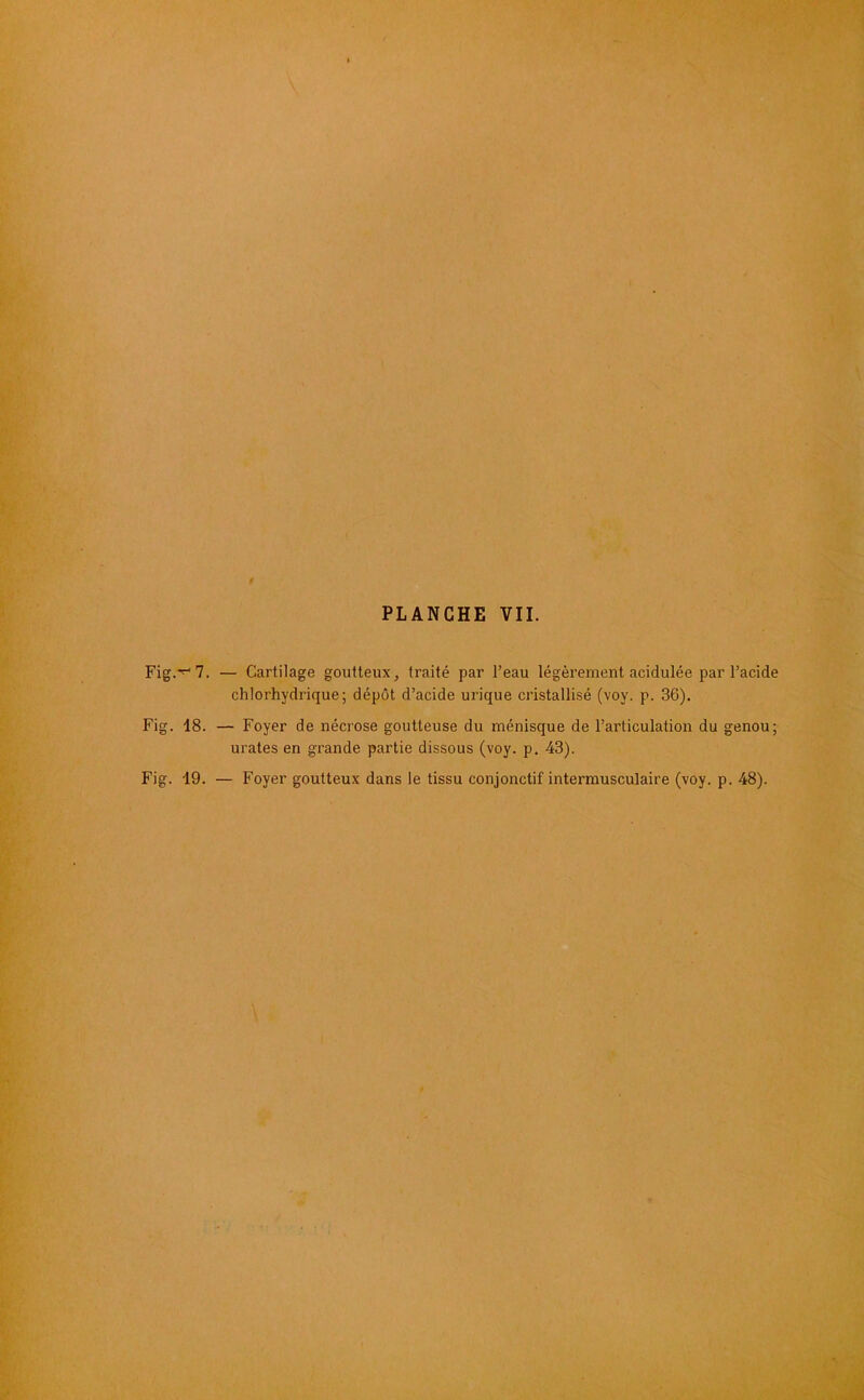 Fig.-^ 7. Fig. 18. Fig. 19. — Cartilage goutteux, traité par l’eau légèrement acidulée par l’acide chlorhydrique; dépôt d’acide urique cristallisé (voy. p. 36). — Foyer de nécrose goutteuse du ménisque de l’articulation du genou; urates en grande partie dissous (voy. p. 43). — Foyer goutteux dans le tissu conjonctif interrausculaire (voy. p. 48).