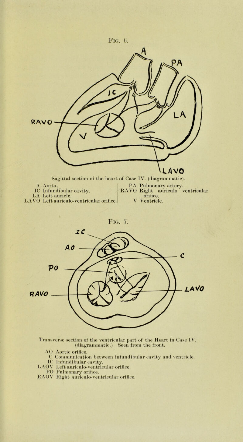 Fig. 6. Sagittal section of the heart of Case IV. (diagrammatic). A Aorta. IC Infundibular cavity. LA Left auricle. LA VO Leftauriculo-ventricular orifice. PA Pulmonary artery. RAVO Right auriculo ventricular orifice. V Ventricle. Fig. 7. T ransverse section of the ventricular part of the Heart in Case IV. (diagrammatic.) Seen from the front. AO Aortic orifice. C Communication between infundibular cavity and ventricle. IC Infundibular cavity. LAOV Leftauriculo-ventricular orifice. PO Pulmonary orifice. RAOV Right auriculo-ventricular orifice.