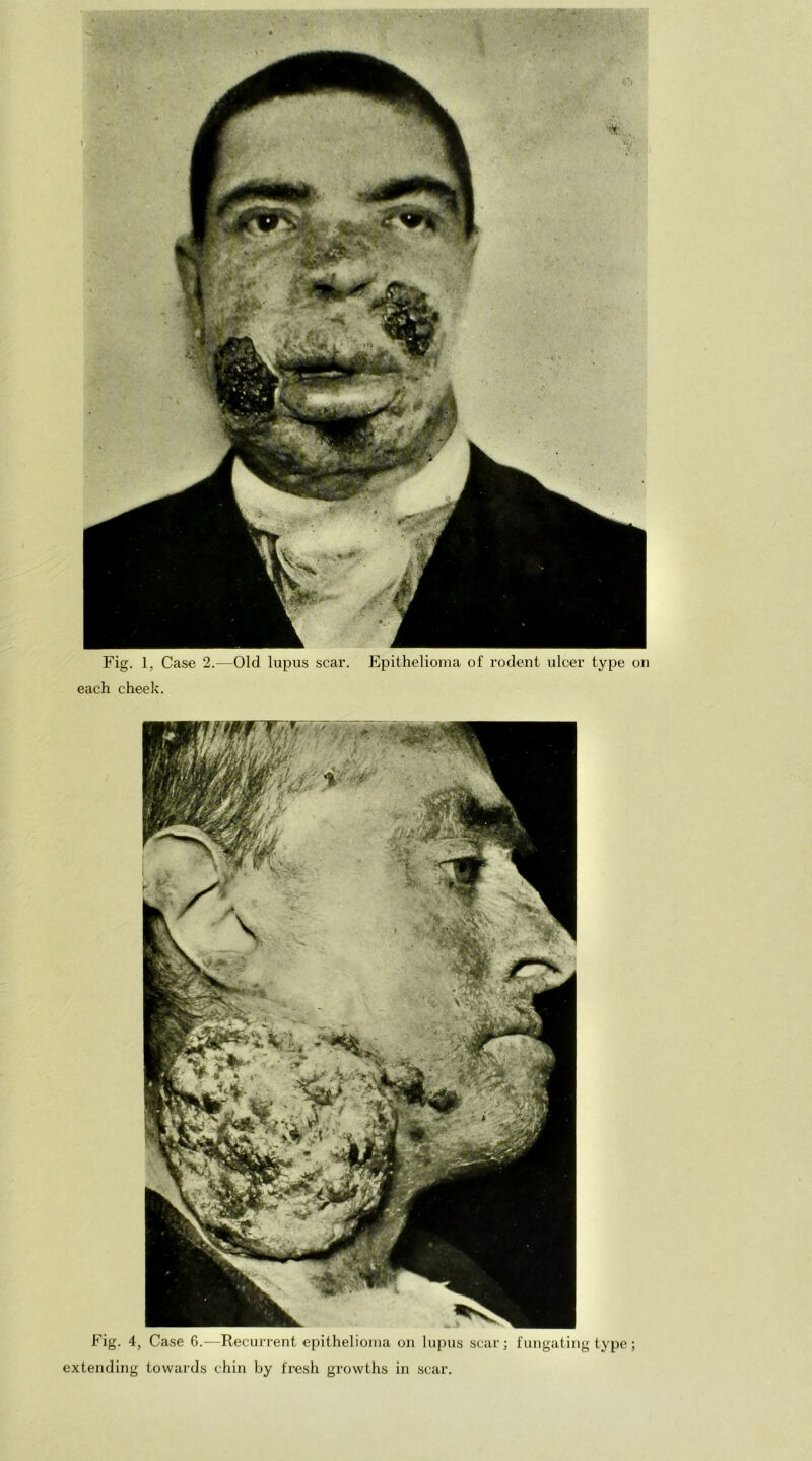 Fig. 1, Case 2.—Old lupus scar. Epithelioma of rodent ulcer type on each cheek. Fig. 4, Case 6.—Recurrent epithelioma on lupus scar; fungating type; extending towards chin by fresh growths in scar.