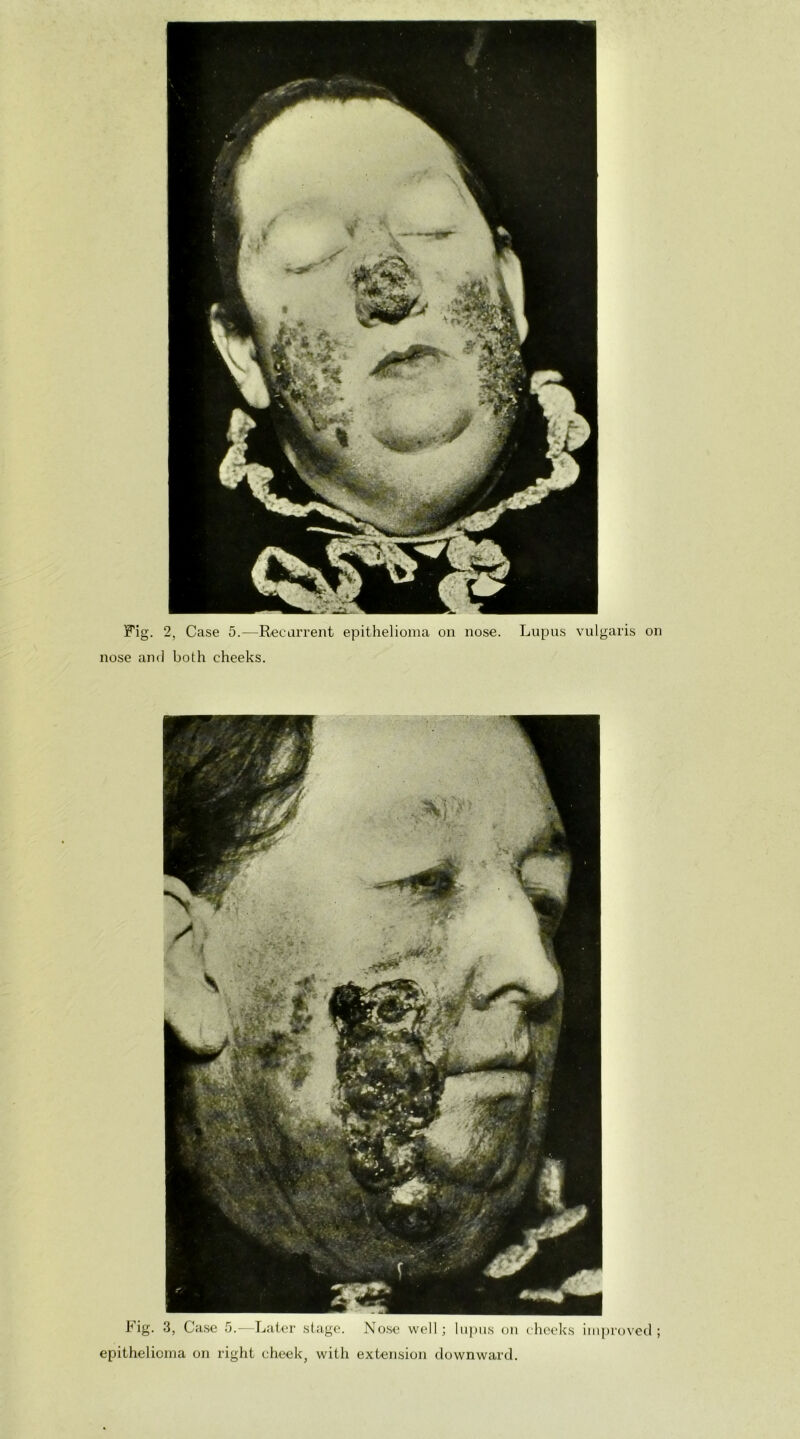 Fig. 2, Case 5.—Recurrent epithelioma on nose. Lupus vulgaris on nose and both cheeks. Fig- 3, Case 5.-—Later stage. Nose well; lupus on cheeks improved; epithelioma on light cheek, with extension downward.