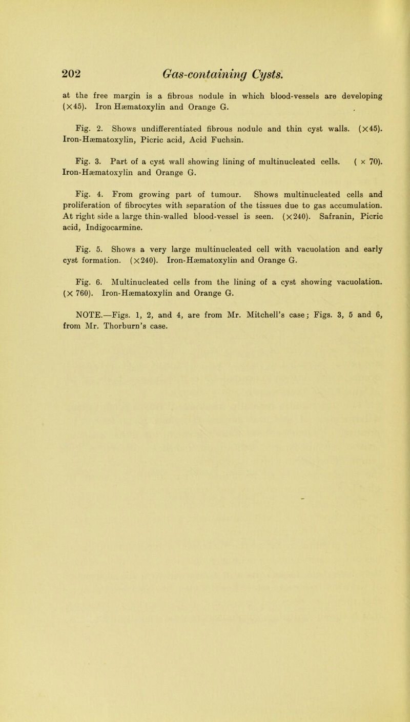 at the free margin is a fibrous nodule in which blood-vessels are developing (X45). Iron Hsematoxylin and Orange G. Fig. 2. Shows undifferentiated fibrous nodule and thin cyst walls. (X45). Iron-Hsematoxylin, Picric acid, Acid Fuchsin. Fig. 3. Part of a cyst wall showing lining of multinucleated cells. ( x 70). Iron-Hsematoxylin and Orange G. Fig. 4. From growing part of tumour. Shows multinucleated cells and proliferation of fibrocytes with separation of the tissues due to gas accumulation. At right side a large thin-walled blood-vessel is seen. (x240). Safranin, Picric acid, Indigocarmine. Fig. 5. Shows a very large multinucleated cell with vacuolation and early cyst formation. (x240). Iron-Hsematoxylin and Orange G. Fig. 6. Multinucleated cells from the lining of a cyst showing vacuolation. (X 760). Iron-Hsematoxylin and Orange G. NOTE.—Figs. 1, 2, and 4, are from Mr. Mitchell’s case; Figs. 3, 5 and 6, from Mr. Thorburn’s case.