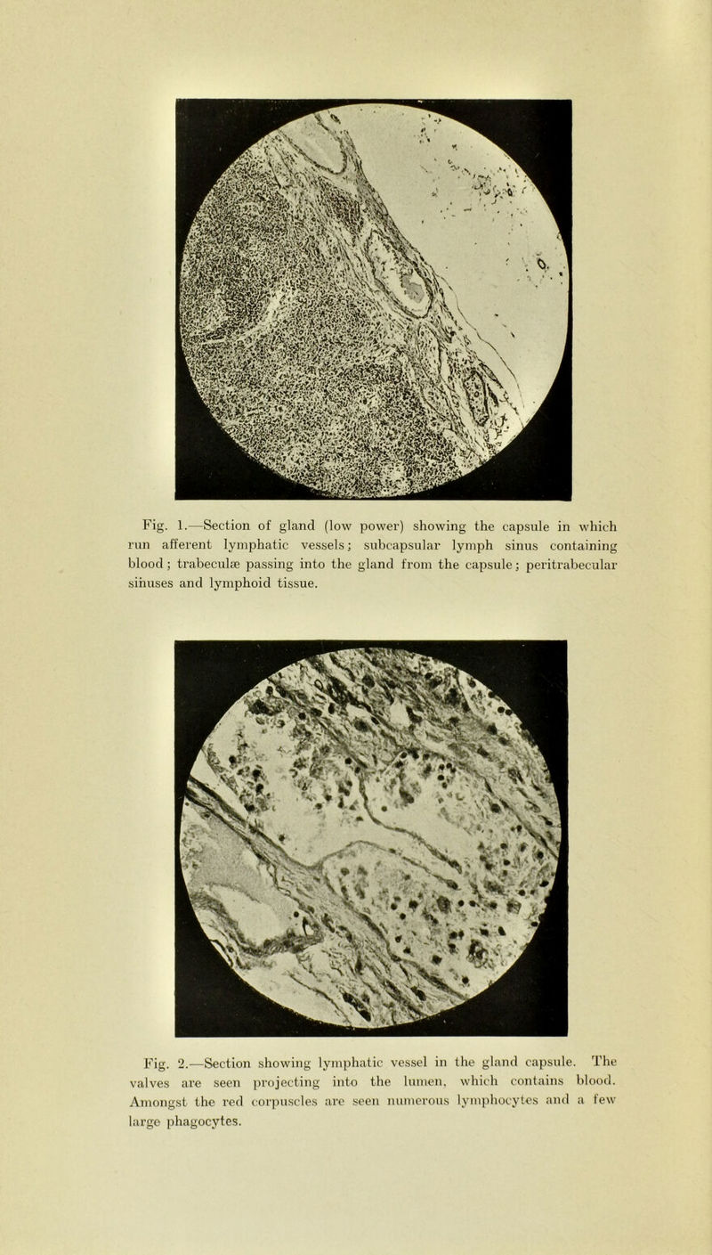 mWIHjmm i_V >v Fig. 1.—Section of gland (low power) showing the capsule in which run afferent lymphatic vessels; subcapsular lymph sinus containing blood; trabeculae passing into the gland from the capsule; peritrabecular sinuses and lymphoid tissue. Fig. 2.—Section showing lymphatic vessel in the gland capsule. The valves are seen projecting into the lumen, which contains blood. Amongst the red corpuscles are seen numerous lymphocytes and a few large phagocytes.