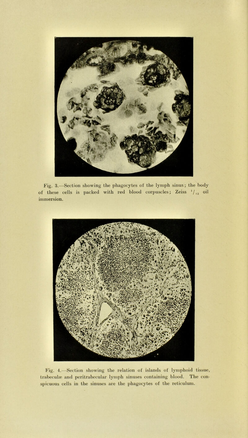 Fig. 3.—Section showing the phagocytes of the lymph sinus; the body of these cells is packed with red blood corpuscles; Zeiss 1 /,, oil immersion. * fcA mmm sMg’ Fig. 4.—Section showing the relation of islands of lymphoid tissue, trabeculae and peritrabecular lymph sinuses containing blood. The con- spicuous cells in the sinuses are the phagocytes of the reticulum.