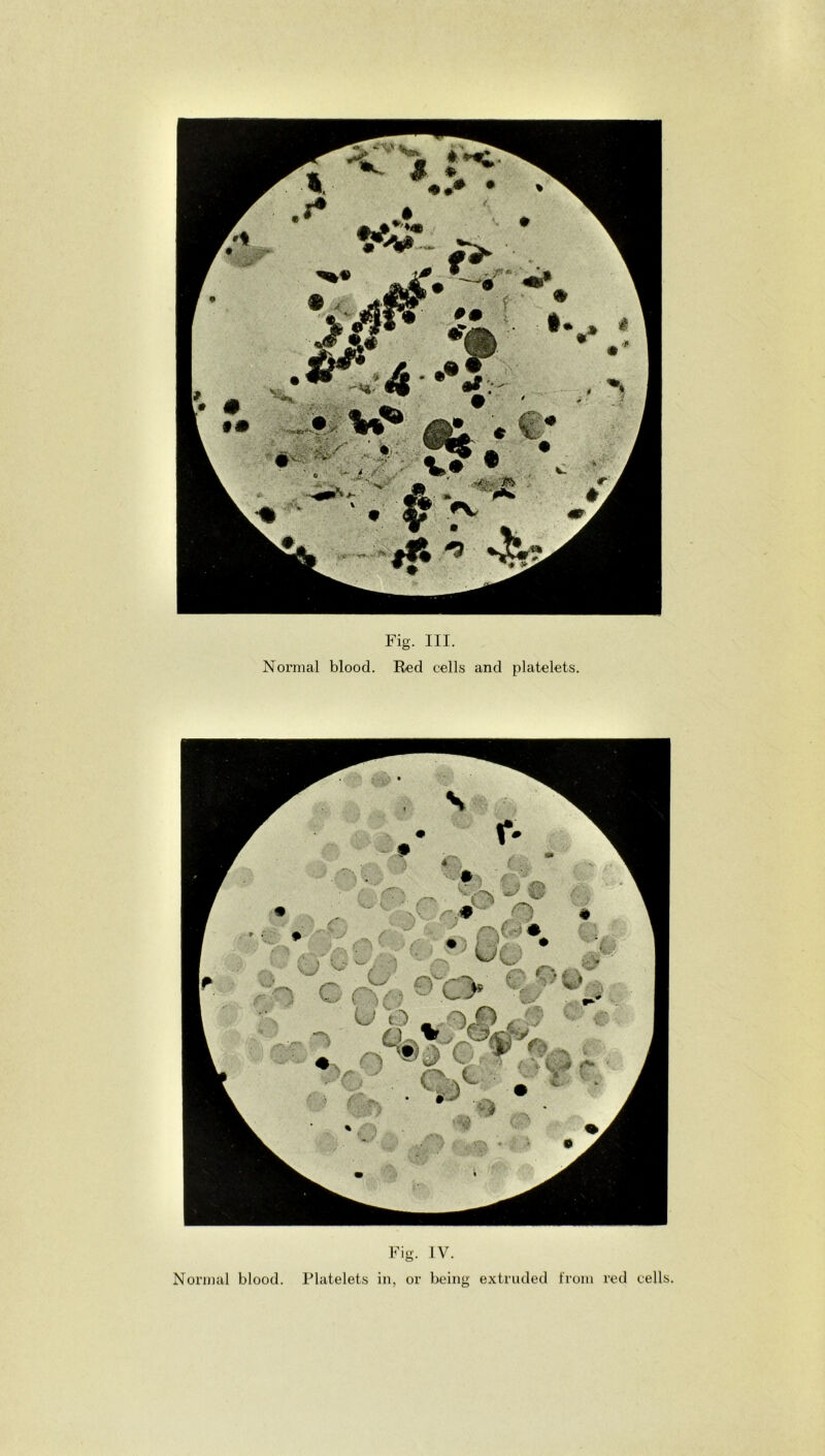 Normal blood. Red cells and platelets. Fig. IV. Normal blood. Platelets in, or being extruded from red cells.