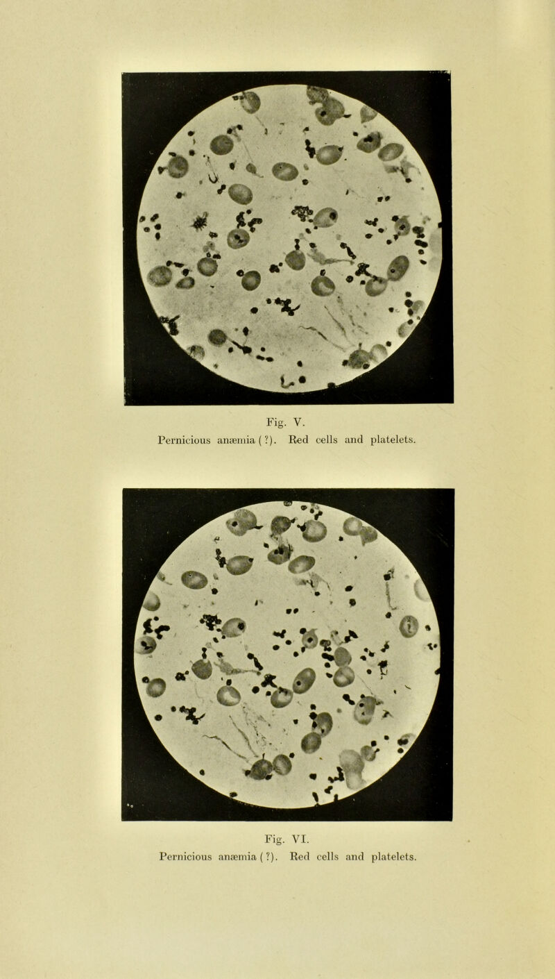 Pernicious anaemia (?). Red cells and platelets. Fig. VI. Pernicious anaemia (?). Red cells and platelets.