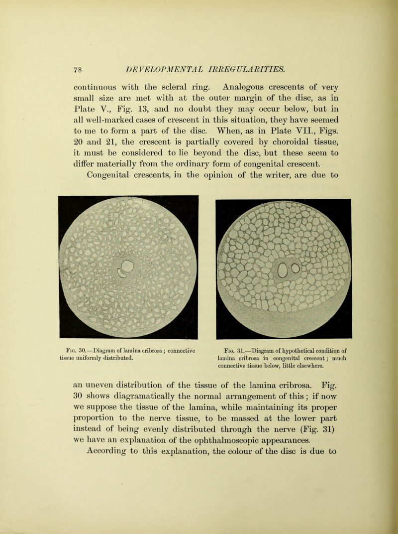 continuous with the scleral ring. Analogous crescents of very small size are met with at the outer margin of the disc, as in Plate V., Fig. 13, and no doubt they may occur below, but in all well-marked cases of crescent in this situation, they have seemed to me to form a part of the disc. When, as in Plate VII., Figs. 20 and 21, the crescent is partially covered by choroidal tissue, it must be considered to lie beyond the disc, but these seem to differ materially from the ordinary form of congenital crescent. Congenital crescents, in the opinion of the writer, are due to Fig. 31.—Diagram of hypothetical condition of lamina cribrosa in congenital crescent; much connective tissue below, little elsewhere. an uneven distribution of the tissue of the lamina cribrosa. Fig. 30 shows diagramatically the normal arrangement of this ; if now we suppose the tissue of the lamina, while maintaining its proper proportion to the nerve tissue, to be massed at the lower part instead of being evenly distributed through the nerve (Fig. 31) we have an explanation of the ophthalmoscopic appearances. According to this explanation, the colour of the disc is due to Fig. 30.—Diagram of lamina cribrosa; connective tissue uniformly distributed.