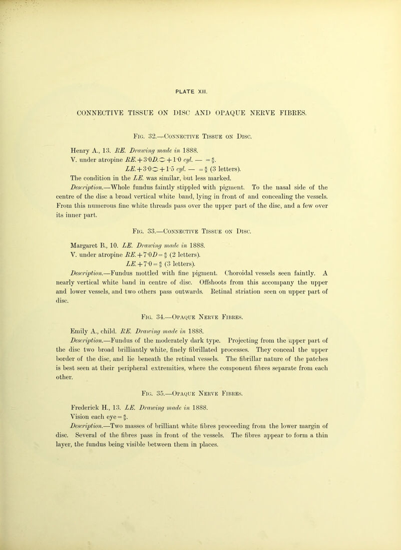 CONNECTIVE TISSUE ON DISC AND OPAQUE NERVE FIBRES. Fig. 32.—Connective Tissue on Disc. Henry A., 13. RE. Drawing made in 1888. V. under atropine iL6,. + 3-0ZtO + l-0 cyl. — =f. LE. + 3'Oo + 1'5 cyl. — =f (3 letters). The condition in the LE. was similar, but less marked. Description.—Whole fundus faintly stippled with pigment. To the nasal side of the centre of the disc a broad vertical white band, lying in front of and concealing the vessels. From this numerous fine white threads pass over the upper part of the disc, and a few over its inner part. Fig. 33.—Connective Tissue on Disc. Margaret B., 10. LE. Drawing made in 1888. V. under atropine RE. + 7'0D = f (2 letters). LE. + 7’0 = f (3 letters). Description.—Fundus mottled with fine pigment. Choroidal vessels seen faintly. A nearly vertical white band in centre of disc. Offshoots from this accompany the upper and lower vessels, and two others pass outwards. Retinal striation seen on upper part of disc. Fig. 34.—Opaque Nerve Fibres. Emily A., child. RE. Drawing made in 1888. Description.—Fundus of the moderately dark type. Projecting from the upper part of the disc two broad brilliantly white, finely fibrillated processes. They conceal the upper border of the disc, and lie beneath the retinal vessels. The fibrillar nature of the patches is best seen at their peripheral extremities, where the component fibres separate from each other. Fig. 35.—Opaque Nerve Fibres. Frederick H., 13. LE. Drawing made in 1888. Vision each eye = f. Description.—Two masses of brilliant white fibres proceeding from the lower margin of disc. Several of the fibres pass in front of the vessels. The fibres appear to form a thin layer, the fundus being visible between them in places.