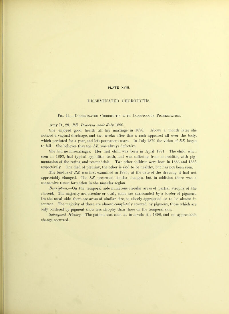 DISSEMINATED CHOROIDITIS. Eig. 44.—Disseminated Choroiditis with Conspicuous Pigmentation. Amy D., 29. IiE. Drawing made July 1890. She enjoyed good health till her marriage in 1878. About a month later she noticed a vaginal discharge, and two weeks after this a rash appeared all over the body, which persisted for a year, and left permanent scars. In July 1879 the vision of HE. began to fail. She believes that the LE. was always defective. She had no miscarriages. Her first child was born in April 1881. The child, when seen in 1893, had typical syphilitic teeth, and was suffering from choroiditis, with pig- mentation of the retina, and recent iritis. Two other children were born in 1883 and 1885 respectively. One died of pleurisy, the other is said to be healthy, but has not been seen. The fundus of RE. was first examined in 1885; at the date of the drawing it had not appreciably changed. The LE. presented similar changes, but in addition there was a connective tissue formation in the macular region. Description.—On the temporal side numerous circular areas of partial atrophy of the choroid. The majority are circular or oval; some are surrounded by a border of pigment. On the nasal side there are areas of similar size, so closely aggregated as to be almost in contact. The majority of these are almost completely covered by pigment, those which are only bordered by pigment show less atrophy than those on the temporal side. Subsequent History.—The patient was seen at intervals till 1896, and no appreciable change occurred.