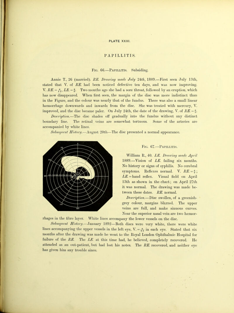 PAPILLITIS. Fig. 66.—Papillitis. Subsiding. Annie T., 26 (married). RE. Drawing made July 24th, 1889.—First seen July 13tli, stated that Y. of RE. had been noticed defective ten days, and was now improving. V. RE. = jR2-, LE. = f. Two months ago she had a sore throat, followed by an eruption, which has now disappeared. When first seen, the margin of the disc was more indistinct than in the Figure, and the colour was nearly that of the fundus. There was also a small linear luemorrhage downwards and inwards from the disc. She was treated with mercury, Y. improved, and the disc became paler. On July 24th, the date of the drawing, V. of RE. = f. Description.—The disc shades off gradually into the fundus without any distinct boundary line. The retinal veins are somewhat tortuous. Some of the arteries are accompanied by white lines. Subsequent History.—August 20th—The disc presented a normal appearance. Fig. 67.—Papillitis. William R, 40. LE. Drawing made April 1889.—Vision of LE. failing six months. No history or signs of syphilis. No cerebral symptoms. Keflexes normal. Y. RE. = f ; LE. — hand reflex. Visual field on April 13th as shown in the chart; on April 27th it was normal. The drawing was made be- tween these dates. RE. normal. Description.—Disc swollen, of a greenish- grey colour, margins blurred. The upper veins are full, and make sinuous curves. Near the superior nasal vein are two hemor- rhages in the fibre layer. White lines accompany the lower vessels on the disc. Stibsequent History.—January 1892—Both discs were very white, there were white lines accompanying the upper vessels in the left eye, Y. = T\ in each eye. Stated that six months after the drawing was made he went to the Eoyal London Ophthalmic Hospital for failure of the RE. The LE. at this time had, he believed, completely recovered. He attended as an out-patient, but had lost his notes. The RE. recovered, and neither eye has given him any trouble since.