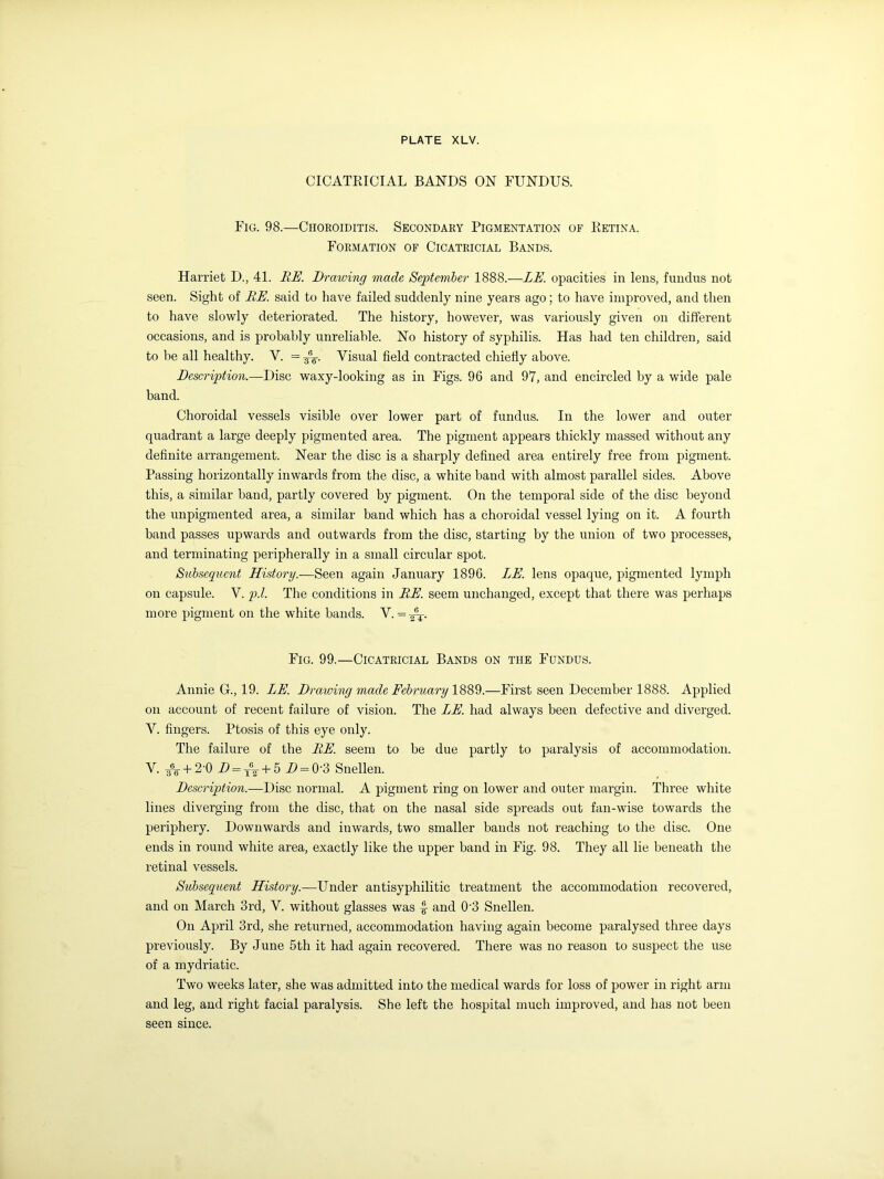 CICATRICIAL BANDS ON FUNDUS. Fig. 98.—Choroiditis. Secondary Pigmentation of Retina. Formation of Cicatricial Bands. Harriet D., 41. RE. Drawing made September 1888.—LE. opacities in lens, fundus not seen. Sight of RE. said to have failed suddenly nine years ago; to have improved, and then to have slowly deteriorated. The history, however, was variously given on different occasions, and is probably unreliable. No history of syphilis. Has had ten children, said to be all healthy. V. = -£%. Visual field contracted chiefly above. Description.—Disc waxy-looking as in Figs. 96 and 97, and encircled by a wide pale band. Choroidal vessels visible over lower part of fundus. In the lower and outer quadrant a large deeply pigmented area. The pigment appears thickly massed without any definite arrangement. Near the disc is a sharply defined area entirely free from pigment. Passing horizontally inwards from the disc, a white band with almost parallel sides. Above this, a similar band, partly covered by pigment. On the temporal side of the disc beyond the unpigmented area, a similar band which has a choroidal vessel lying on it. A fourth hand passes upwards and outwards from the disc, starting by the union of two processes, and terminating peripherally in a small circular spot. Subsequent History.—Seen again January 1896. LE. lens opaque, pigmented lymph on capsule. V. p.l. The conditions in RE. seem unchanged, except that there was perhaps more pigment on the white bands. V. = Ay. Fig. 99.—Cicatricial Bands on the Fundus. Annie Gr., 19. LE. Drawing made February 1889.—First seen December 1888. Applied on account of recent failure of vision. The LE. had always been defective and diverged. V. fingers. Ptosis of this eye only. The failure of the RE. seem to be due partly to paralysis of accommodation. V. 36e+2R Z> = xV + 5 D = 0-3 Snellen. Description.—Disc normal. A pigment ring on lower and outer margin. Three white lines diverging from the disc, that on the nasal side spreads out fan-wise towards the periphery. Downwards and inwards, two smaller bands not reaching to the disc. One ends in round white area, exactly like the upper band in Fig. 98. They all lie beneath the retinal vessels. Subsequent History.—Under antisyphilitic treatment the accommodation recovered, and on March 3rd, V. without glasses was and 03 Snellen. On April 3rd, she returned, accommodation having again become paralysed three days previously. By June 5th it had again recovered. There was no reason to suspect the use of a mydriatic. Two weeks later, she was admitted into the medical wards for loss of power in right arm and leg, and right facial paralysis. She left the hospital much improved, and has not been seen since.