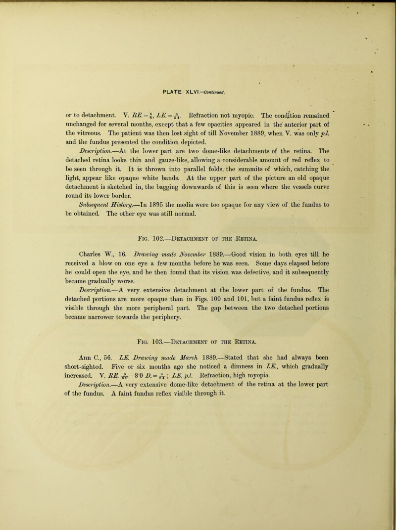 PLATE XLVI.—Continued. or to detachment. Y. BE. = £, LE. = Refraction not myopic. The condition remained unchanged for several months, except that a few opacities appeared in the anterior part of the vitreous. The patient was then lost sight of till November 1889, when Y. was only p.l. and the fundus presented the condition depicted. Description.—At the lower part are two dome-like detachments of the retina. The detached retina looks thin and gauze-like, allowing a considerable amount of red reflex to be seen through it. It is thrown into parallel folds, the summits of which, catching the light, appear like opaque white bands. At the upper part of the picture an old opaque detachment is sketched in, the bagging downwards of this is seen where the vessels curve round its lower border. Subsequent History.—In 1895 the media were too opaque for any view of the fundus to be obtained. The other eye was still normal. Fig. 102.—Detachment of the Retina. Charles W., 16. Drawing made November 1889.—Good vision in both eyes till he received a blow on one eye a few months before he was seen. Some days elapsed before he could open the eye, and he then found that its vision was defective, and it subsequently became gradually worse. Description.—A very extensive detachment at the lower part of the fundus. The detached portions are more opaque than in Figs. 100 and 101, but a faint fundus reflex is visible through the more peripheral part. The gap between the two detached portions became narrower towards the periphery. Fig. 103.—Detachment of the Retina. Ann C., 56. LE. Drawing made March 1889.—Stated that she had always been short-sighted. Five or six months ago she noticed a dimness in LE., which gradually increased. V. RE. - 8 0 D. = ; LE. p.l. Refraction, high myopia. Description.—A very extensive dome-like detachment of the retina at the lower part of the fundus. A faint fundus reflex visible through it.