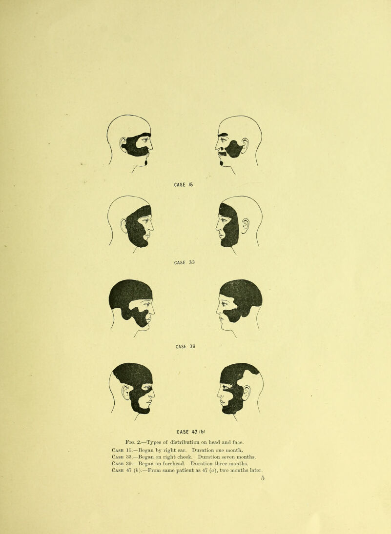 CASE 33 CASE 39 CASE 4-7 (bl Fig. 2.-—Types of distribution on head and face. Case 15.—Began by right ear. Duration one month. Case 33.—Began on right cheek. Duration seven months. Case 39.—Began on forehead. Duration three months. Case 47 (6).—From same patient as 47 (a), two months later.