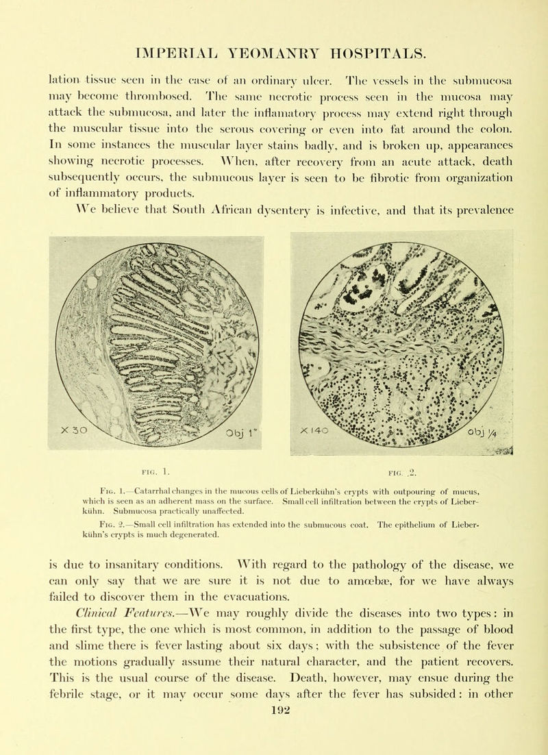 lation tissue seeu in tlie case of an ordinary nleei’. Tlie vessels in the snbinneosa may become tbroml)osed. ddie same necrotic process seen in the mneosa may attack the snbmneosa, and later the inflamatory process may extend right through the mnsenlar tissue into the serous covering or even into fat around the colon. In some instances the mnsenlar layer stains badly, and is broken np, appearances showing necrotic processes. ^Vhen, after recovery from an acute attack, death subsequently occurs, the snbmneons layer is seen to be fibrotic from organization of inflammatory products. We belicA'c that South African dysentery is infective, and that its prevalence FIf!. 1. FIfi, ,2. Fig. 1.—Catarrhal changes in the mucous cells of Lieberkiilin’s crypts with outpouring of mucus, which is seen as an adherent mass on the surface. Small cell infiltration between the crypts of Lieber- kiihn. Submucosa practically unaffected. Fig. 2.—Small cell infiltration has extended into the submucous coat. The epithelium of Lieber- kiihn’s crypts is much degenerated. is due to insanitary conditions. With regard to the pathology of the disease, we can only say that we are sure it is not due to amoebat, for we have always failed to discover them in the evacuations. Clinical Features.—We may roughly divide the diseases into two types: in the first type, the one which is most common, in addition to the passage of blood and slime there is fever lasting about six days; with the subsistence of the fever the motions gradually assume their natural character, and the patient recovers. This is the usual course of tlie disease. Heath, however, may ensue during the febrile stage, or it may occur some days after tlie fever has subsided : in other