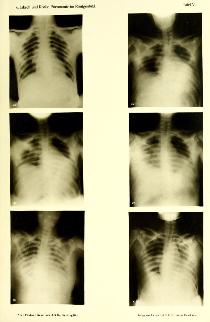 V. Jaksch und Rolk\, Pneumonie im Röntgenbild. Tafel \.