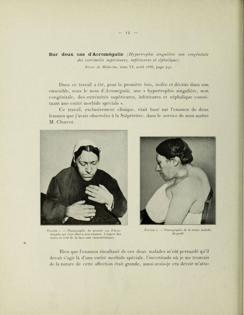 Sur deux cas d’Acromégalie (Hypertrophie singulière non congénitale des extrémités supérieures, inférieures et céphalique). Revue de Médecine, tome \’I, avril 1886, page 297. Dans ce travail a été, pour la première fois, isolée et décrite dans son ensemble, sous le nom à)Acromégalie, une « hypertrophie singulière, non congénitale, des extrémités supérieures, inférieures et céphalique consti- tuant une entité morbide spéciale ». Ce travail, exclusivement clinique, était basé sur l’examen de deux femmes que j’avais observées à la Salpêtrière, dans le service de mon maître M. Charcot. l'iüURE I. — Photographie du premier cas d’Acro- mégalie qui s’est offert à mon examen. L’aspect des mains et celui de la face sont caractéristiques. Fioure 2. — Photographie de la même malade, de profil. Bien que l’examen simultané de ces deux malades m’eût persuadé qu’il devait s’agir là d’une entité morbide spéciale, l’incertitude où je me trouvais de la nature de cette affection était grande, aussi avais-je cru devoir m’atta-