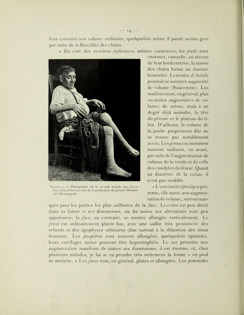 bras conserve son volume ordinaire, quelquefois même il paraît moins gros par suite de la flaccidité des chairs. « Du côté des membres inférieurs, mêmes caractères; pieds sont énormes, camards ; au niveau de leur bord externe, la masse des chairs forme un énorme bourrelet, hetendoii d’Achille pourrait se montrer augmenté de volume (Saucerotte). Les malléole s en général, plus ou moins augmentées de vo- lume ; de même, mais à un degré déjà moindre, la tête du péroné et le plateau du ti- bia. D’ailleurs, le volume de la jambe proprement dite ne se trouve pas notablement accru. Les_gc//(3//x se montrent souvent saillants, en avant, par suite de l’augmentation de volume de la rotule et de celle des condyles du fémur. Quant au diamètre de la cuisse, il n’est pas modifié. « L'extrémitécéplialiquepré- sente, elle aussi, une augmen- tation de volume, surtout mar- quée pour les parties les plus saillantes de la face. Le crâne est peu altéré dans sa forme et ses dimensions, ou du moins ses altérations sont peu apparentes; la face, au contraire, se montre allongée verticalement. Le fro)it est ordinairement plutôt bas, avec une saillie très prononcée des rebords et des apophyses orbitaires (due surtout à la dilatation des sinus frontaux). Les paupières sont souvent allongées, quelquefois épaissies, leurs cartilages tarses peuvent être hypertrophiés. Le nez présente une augmentation manifeste de toutes ses dimensions; il est énorme, et, chez plusieurs malades, je lui ai vu prendre très nettement la forme « en pied de marmite. » joues sont, en général, plates et allongées. Les pommettes l'iüL'Ulc 3. — Photographie de la seconde malade que j’ai eu l’ociasion d'observer lors de la publication du premier .Mémoire sur l’Acromégalie