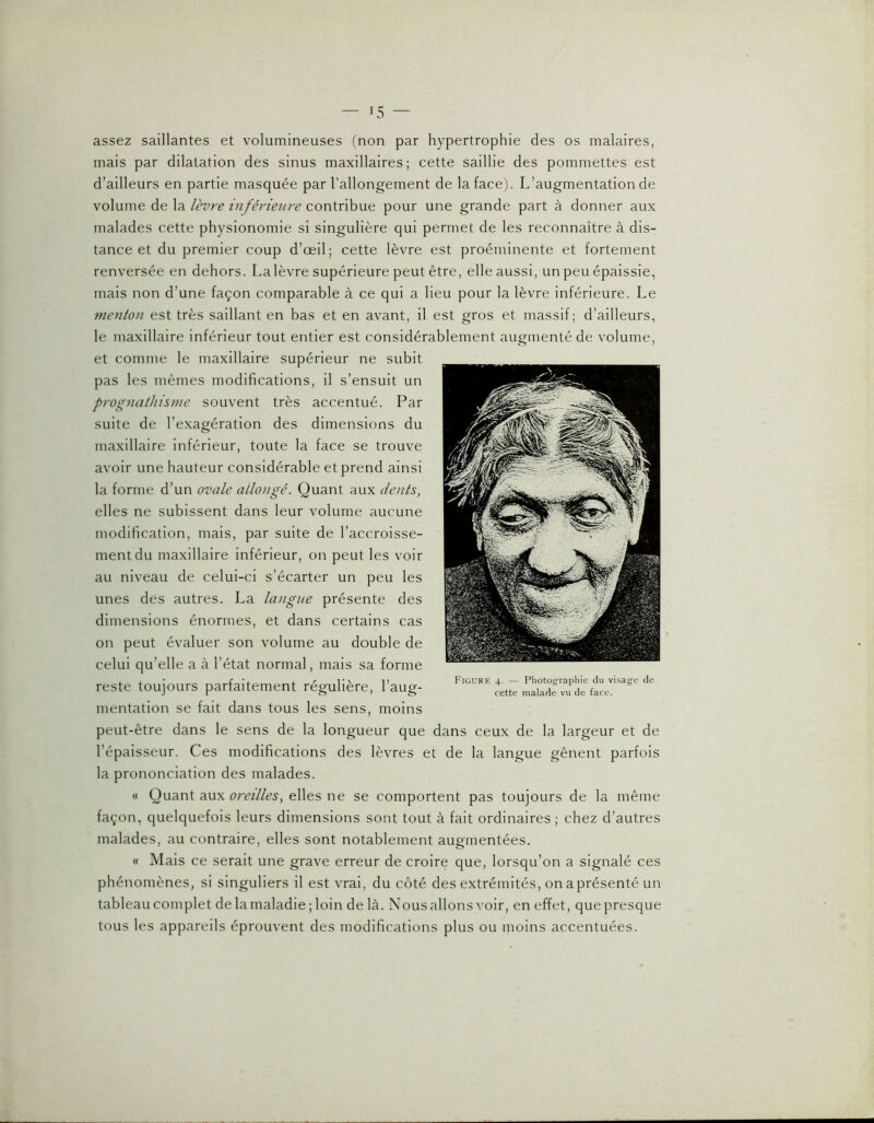 — ï5 — assez saillantes et volumineuses (non par hypertrophie des os malaires, mais par dilatation des sinus maxillaires; cette saillie des pommettes est d’ailleurs en partie masquée par l’allongement de la face). L’augmentation de volume de la lèvre inférieure contribue pour une grande part à donner aux malades cette physionomie si singulière qui permet de les reconnaître à dis- tance et du premier coup d’œil; cette lèvre est proéminente et fortement renversée en dehors. Lalèvre supérieure peut être, elle aussi, un peu épaissie, mais non d’une façon comparable à ce qui a lieu pour la lèvre inférieure. Le menton est très saillant en bas et en avant, il est gros et massif; d’ailleurs, le maxillaire inférieur tout entier est considérablement augmenté de volume, et comme le maxillaire supérieur ne subit pas les mêmes modifications, il s’ensuit un prognathisme souvent très accentué. Par suite de l’exagération des dimensions du maxillaire inférieur, toute la face se trouve avoir une hauteur considérable et prend ainsi la forme d’un ovale allongé. Quant aux dents, elles ne subissent dans leur volume aucune modification, mais, par suite de l’accroisse- ment du maxillaire inférieur, on peut les voir au niveau de celui-ci s’écarter un peu les unes des autres. La langue présente des dimensions énormes, et dans certains cas on peut évaluer son volume au double de celui qu’elle a à l’état normal, mais sa forme reste toujours parfaitement régulière, l’aug- mentation se fait dans tous les sens, moins peut-être dans le sens de la longueur que dans ceux de la largeur et de l’épaisseur. Ces modifications des lèvres et de la langue gênent parfois la prononciation des malades. « Quant aux oreilles, elles ne se comportent pas toujours de la même façon, quelquefois leurs dimensions sont tout à fait ordinaires; chez d’autres malades, au contraire, elles sont notablement augmentées. « Mais ce serait une grave erreur de croire que, lorsqu’on a signalé ces phénomènes, si singuliers il est vrai, du côté des extrémités, on a présenté un tableau complet de la maladie ; loin de là. Nous allons voir, en effet, que presque tous les appareils éprouvent des modifications plus ou moins accentuées.