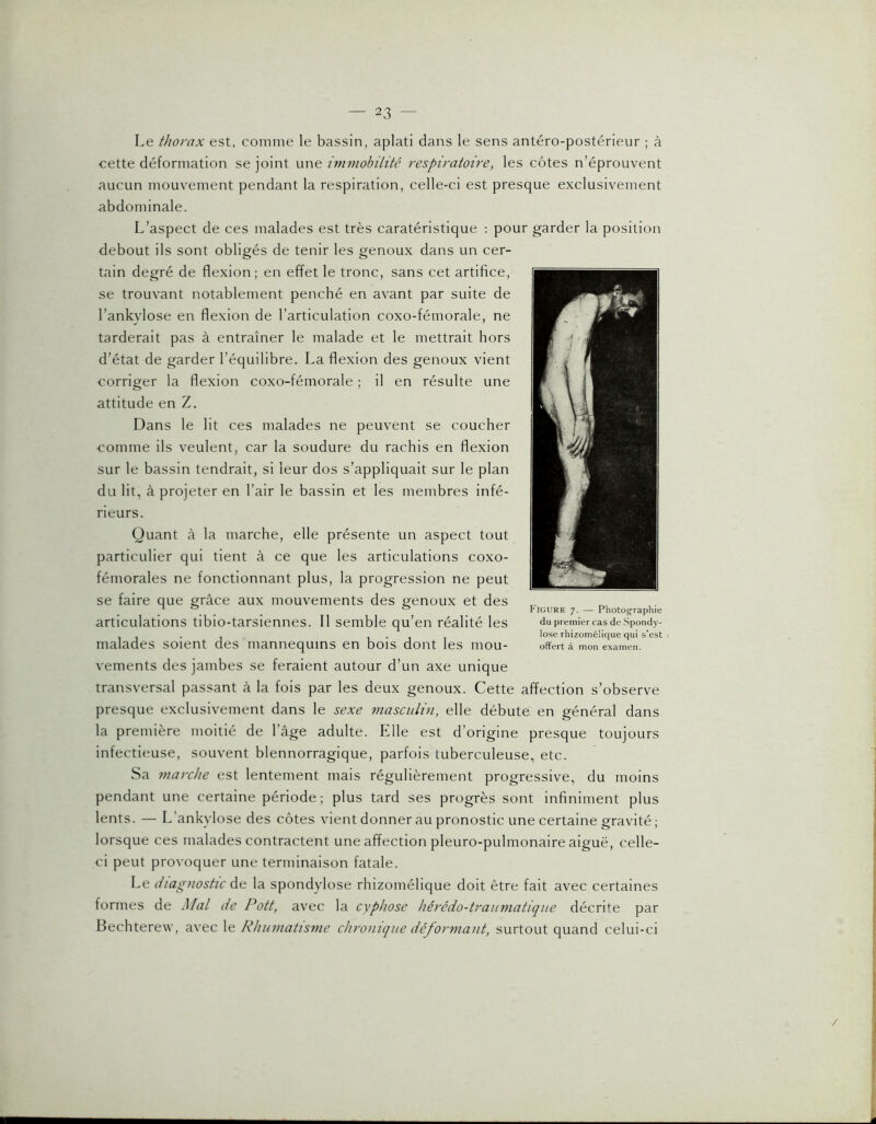 Le thorax est, comme le bassin, aplati dans le sens antéro-postérieur ; à cette déformation se joint une immobilité respiratoire, les côtes n’éprouvent aucun mouvement pendant la respiration, celle-ci est presque exclusivement abdominale. L’aspect de ces malades est très caratéristique : pour garder la position debout ils sont obligés de tenir les genoux dans un cer- tain degré de flexion; en effet le tronc, sans cet artifice, se trouvant notablement penché en avant par suite de l’ankylose en flexion de l’articulation coxo-fémorale, ne tarderait pas à entraîner le malade et le mettrait hors d’état de garder l’équilibre. La flexion des genoux vient corriger la flexion coxo-fémorale ; il en résulte une attitude en Z. Dans le Ht ces malades ne peuvent se coucher comme ils veulent, car la soudure du rachis en flexion sur le bassin tendrait, si leur dos s’appliquait sur le plan du lit, à projeter en l’air le bassin et les membres infé- rieurs. Quant à la marche, elle présente un aspect tout particulier qui tient à ce que les articulations coxo- fémorales ne fonctionnant plus, la progression ne peut se faire que grâce aux mouvements des genoux et des articulations tibio-tarsiennes. Il semble qu’en réalité les malades soient des mannequins en bois dont les mou- vements des jambes se feraient autour d’un axe unique transversal passant à la fois par les deux genoux. Cette affection s’observe presque exclusivement dans le sexe masculin, elle débute en général dans la première moitié de l’âge adulte. Elle est d’origine presque toujours infectieuse, souvent blennorragique, parfois tuberculeuse, etc. Sa marche est lentement mais régulièrement progressive, du moins pendant une certaine période; plus tard ses progrès sont infiniment plus lents. — L’ankvlose des côtes vient donner au pronostic une certaine gravité ; lorsque ces malades contractent une affection pleuro-pulmonaire aiguë, celle- ci peut provoquer une terminaison fatale. Le diagnostic de la spondylose rhizomélique doit être fait avec certaines formes de Mal de Pott, avec la cyphose hérédo-traiimatiqne décrite par Bechterew, avec le Rhumatisme chronique déformant, surtout quand celui-ci Figure 7. — Photog^raphie du premier cas de Spondy- lose rhizomélique qui s’est offert à mon examen. /