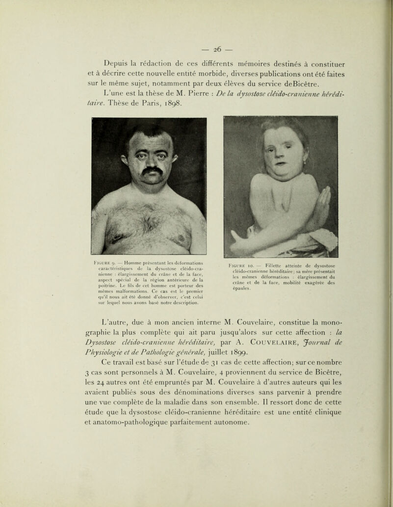 2Ô Depuis la rédaction de ces différents mémoires destinés à constituer et à décrire cette nouvelle entité morbide, diverses publications ont été faites sur le même sujet, notamment par deux élèves du service deBicêtre. L’une est la thèse de M. Pierre : De la dysostose clêido-cranienne hérédi- taire. Thèse de Paris, 1898. Figure g. — Homme présentant les déformations caractéristiques de la dysostose cléido-cra- nienne : élarg'issement du crâne et de la face, aspect spécial de la région antérieure de la poitrine. Le fils de cet homme est porteur des mêmes malformations. Ce cas est le premier qu’il nous ait été donné d’observer, c’est celui sur lequel nous avons basé notre description. Figure io. — Fillette atteinte de dysostose cléido-cranienne héréditaire; .sa mère présentait les mêmes déformations : élargissement du crâne et de la face, mobilité exagérée des épaules. L’autre, due à mon ancien interne M. Couvelaire, constitue la mono- graphie la plus complète qui ait paru jusqu’alors sur cette affection : la Dysostose cléido-cranienne héréditaire, par A. CüU VELAI RE, Journal de Physiologie et de Pathologie générale, juillet 1899. Ce travail est basé sur l’étude de 31 cas de cette affection; sur ce nombre 3 cas sont personnels à M. Couvelaire, 4 proviennent du service de Bicêtre, les 24 autres ont été empruntés par M. Couvelaire à d’autres auteurs qui les avaient publiés sous des dénominations diverses sans parvenir à prendre une vue complète de la maladie dans son ensemble. Il ressort donc de cette étude que la dysostose cléido-cranienne héréditaire est une entité clinique et anatomo-pathologique parfaitement autonome.