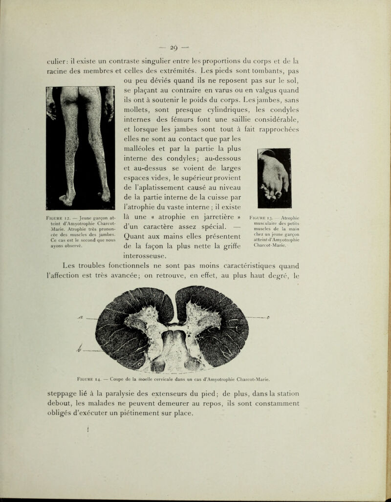 culier; il existe un contraste singulier entre les proportions du corps et de la racine des membres et celles des extrémités. Les pieds sont tombants, pas ou peu déviés quand ils ne reposent pas sur le sol, se plaçant au contraire en varus ou en valgus quand ils ont à soutenir le poids du corps. Les jambes, sans mollets, sont presque cylindriques, les condyles Internes des fémurs font une saillie considérable, et lorsque les jambes sont tout à fait rapprochées elles ne sont au contact que par les malléoles et par la partie la plus interne des condyles; au-dessous et au-dessus se voient de larges espaces vides, le supérieur provient de l’aplatissement causé au niveau de la partie interne de la cuisse par l’atrophie du vaste interne ; il existe là une « atrophie en jarretière » d’un caractère assez spécial. — Quant aux mains elles présentent de la façon la plus nette la griffe interosseuse. Les troubles fonctionnels ne sont pas moins caractéristiques quand l’affection est très avancée; on retrouve, en effet, au plus haut degré, le Figure 12. —Jeune garçon at- teint d'.Amyotrophie Charcot- Marie. Atrophie très pronon- cée des muscles des jambes. Ce cas est le second que nous ayons observé. Figure 13. — Atrophie musculaire des petits muscles de la main chez un jeune g^arçon atteint d’Amyotrophie Charcot-.Marie. Figure 14. — Coupe de la moelle cervicale dans un cas d’Amyotrophie Charcot-Marie. Steppage Hé à la paralysie des extenseurs du pied; de plus, dans la station debout, les malades ne peuvent demeurer au repos, ils sont constamment obligés d’exécuter un piétinement sur place. i