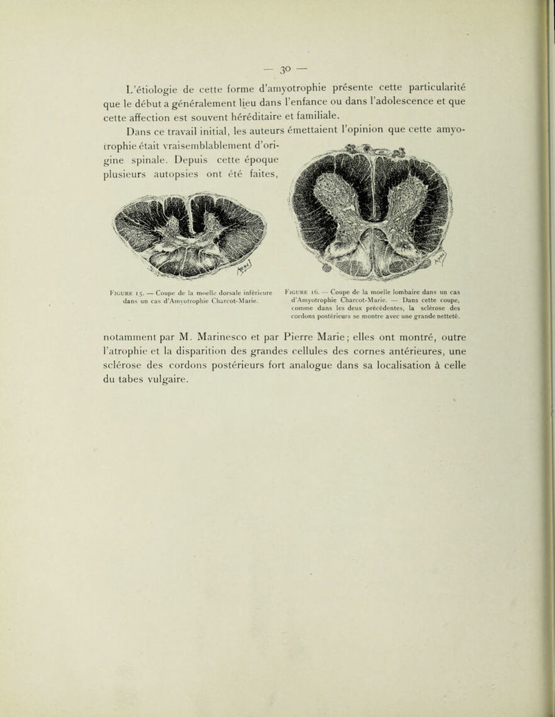 L’étiologie de cette forme d’amyotrophie présente cette particularité que le début a généralement lieu dans l’enfance ou dans 1 adolescence et que cette affection est souvent héréditaire et familiale. Dans ce travail initial, les auteurs émettaient 1 opinion que cette amyo- trophie était vraisemblablement d’ori- gine spinale. Depuis cette époque Figure 15. — Coupe de la moelle dorsale inférieure Figure 16. — Coupe de la moelle lombaire dans un cas dans un cas d’Amyotrophie Charcot-Marie. d’.Amyotrophie Charcot-Marie. — Dans cette coupe, comme dans les deux précédentes, la sclérose des cordons postérieurs se montre avec une g-rande netteté. notamment par M. Marinesco et par Pierre Marie; elles ont montré, outre l’atrophie et la disparition des grandes cellules des cornes antérieures, une sclérose des cordons postérieurs fort analogue dans sa localisation à celle du tabes vulgaire.