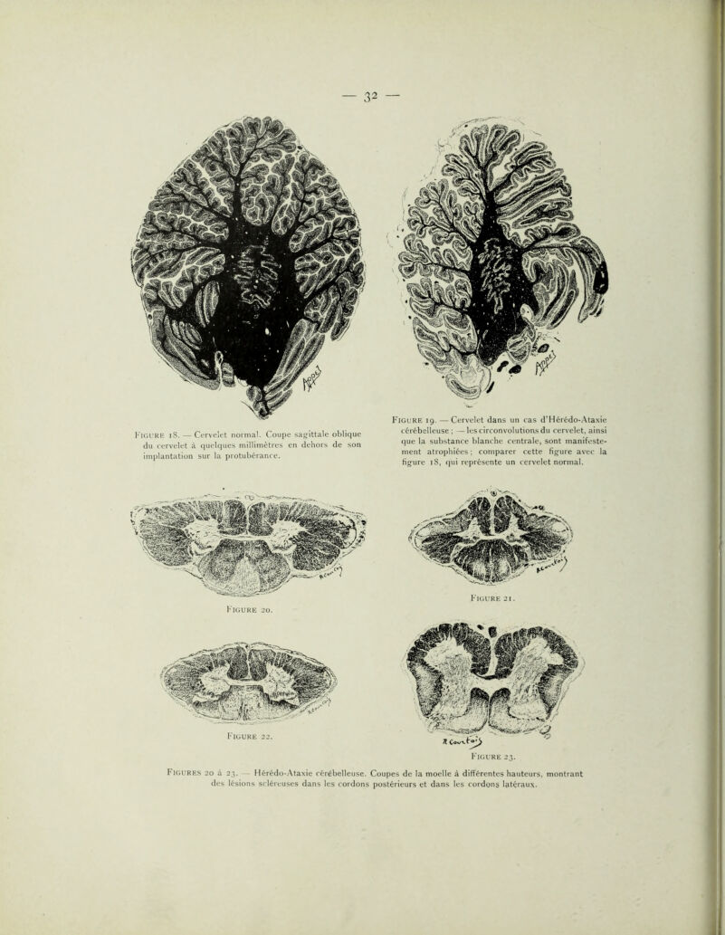 Figure iS. — Cervelet norma]. Coupe sag'ittale oblique du cervelet à ciuelques inilliinètres en dehors de son implantation sur la protubérance. Figure 19. — Cervelet dans un cas d’Hérédo-.Ataxie cérébelleuse; —les circonvolutions du cervelet, ainsi que la substance blanche centrale, sont manifeste- ment atrophiées ; comparer cette figure avec la figure iS, ()ui représente un cervelet normal. F'igure 21. Figure 22. F'igure 23. Figures 20 à 23. 1 lérédo-.Vtaxie cérébelleuse. Coupes de la moelle à différentes hauteurs, montrant des lésions scléreuses dans les cordons postérieurs et dans les cordons latéraux.