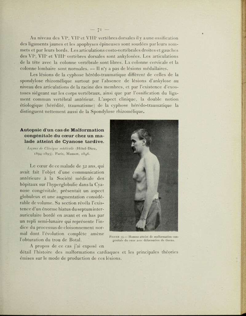 des ligaments jaunes et les apophyses épineuses sont soudées parleurs som- mets et par leurs bords. Les articulations costo-vertébrales droites et gauches des \d', VIL et VIIL vertèbres dorsales sont ankylosées. Les articulations de la tête avec la colonne vertébrale sont libres. La colonne cervicale et la colonne lombaire sont normales. — Il n’y a pas de lésions médullaires. Les lésions de la cyphose hérédo-traumatique diffèrent de celles de la spondylose rhizomélique surtout par l’absence de lésions d’ankylose au niveau des articulations de la racine des membres, et par l’existence d’exos- toses siégeant sur les corps vertébraux, ainsi que par l’ossification du liga- ment commun vertébral antérieur. L’aspect clinique, la double notion étiologique (hérédité, traumatisme) de la cyphose hérédo-traumatique la distinguent nettement aussi de la Spondylose rhizomélique. Autopsie d’un cas de Malformation congénitale du cœur chez un ma- lade atteint de Cyanose tardive. Lapons de Clinique médicale ( Hôtel-Dieu, 1894-1895). Paris, Masson, 1896. Le cœur de ce malade de 32 ans, qui avait fait l’objet d’une communication antérieure à la Société médicale des hôpitaux sur l’hyperglobulie dans la Cya- nose congénitale, présentait un aspect globuleux et une augmentation considé- rable de volume. Sa section révéla l’exis- tence d’un énorme hiatus du septum inter- auriculaire bordé en avant et en bas par un repli semi-lunaire qui représente l’in- dice du processus de cloisonnement nor- mal dont l’évolution complète amène l’obturation du trou de Botal. A propos de ce cas j’ai exposé en détail l’histoire des malformations cardiaques et les principales théories émises sur le mode de production de ces lésions.