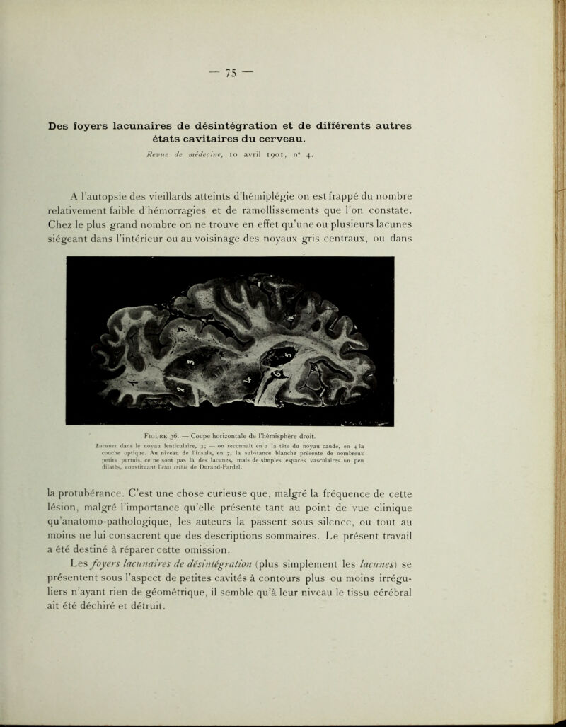 Des foyers lacunaires de désintégration et de différents autres états cavitaires du cerveau. Revue de médecine, lo avril 1901, n“ 4. A l’autopsie des vieillards atteints d’hémiplégie on est frappé du nombre relativement faible d’bémorragies et de ramollissements que l’on constate. Chez le plus grand nombre on ne trouve en effet qu’une ou plusieurs lacunes siégeant dans l’intérieur ou au voisinage des noyaux gris centraux, ou dans Figure 36. — Coupe horizontale de Thémisphère droit. Lacunes dans le noyau lenticulaire, 3] — on reconnaît en 2 la tète du noyau caudé, en 4 la couche optique. Au niveau de Tinsula, en 7, la substance blanche présente de nombreux î)eliis pertuis, ce ne sont pas là des lacunes, mais de simples espaces vasculaires un peu dilatés, constituant Vétat criblé de Durand-Kardel. la protubérance. C’est une chose curieuse que, malgré la fréquence de cette lésion, malgré l’importance qu’elle présente tant au point de vue clinique qu’anatomo-pathologique, les auteurs la passent sous silence, ou tout au moins ne lui consacrent que des descriptions sommaires. Le présent travail a été destiné à réparer cette omission. Les foyers lacunaires de désintégration (plus simplement les lacunes') se présentent sous l’aspect de petites cavités à contours plus ou moins irrégu- liers n’ayant rien de géométrique, il semble qu’à leur niveau le tissu céréoral ait été déchiré et détruit.