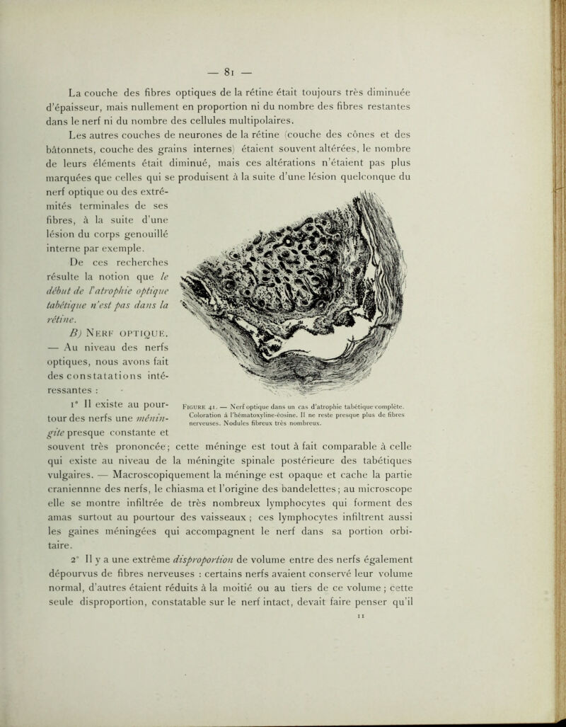 La couche des fibres optiques de la rétine était toujours très diminuée d’épaisseur, mais nullement en proportion ni du nombre des fibres restantes dans le nerf ni du nombre des cellules multipolaires. Les autres couches de neurones de la rétine icouche des cônes et des bâtonnets, couche des grains internes) étaient souvent altérées, le nombre de leurs éléments était diminué, mais ces altérations n’étaient pas plus marquées que celles qui se produisent à la suite d’une lésion quelconque du nerf optique ou des extré- mités terminales de ses fibres, à la suite d’une lésion du corps genouillé interne par exemple. De ces recherches résulte la notion que le liélmt de l'atrophie optique n’est pas dans la B) NkRF OPTIOUK. — Au niveau des nerfs optiques, nous avons fait des constatations inté- ressantes : 1° Il existe au pour- tour des nerfs une ménin- gite presque constante et souvent très prononcée; cette méninge est tout à fait comparable à celle qui existe au niveau de la méningite spinale postérieure des tabétiques vulgaires. — Macroscopiquement la méninge est opaque et cache la partie craniennne des nerfs, le chiasma et l’origine des bandelettes; au microscope elle se montre infiltrée de très nombreux lymphocytes qui forment des amas surtout au pourtour des vaisseaux ; ces lymphocytes infiltrent aussi les gaines méningées qui accompagnent le nerf dans sa portion orbi- taire. 2 Il y a une extrême disproportion de volume entre des nerfs également dépourvus de fibres nerveuses : certains nerfs avaient conservé leur volume normal, d’autres étaient réduits à la moitié ou au tiers de ce volume ; cette seule disproportion, constatable sur le nerf intact, devait faire penser qu’il tabétique rétine. Figure 41. — Nerf optique dans un cas d’atrophie tabétique complète. Coloration à l’hématoxyline-éosine. Il ne reste presque plus de fibres nerveuses. Nodules fibreux très nombreux.