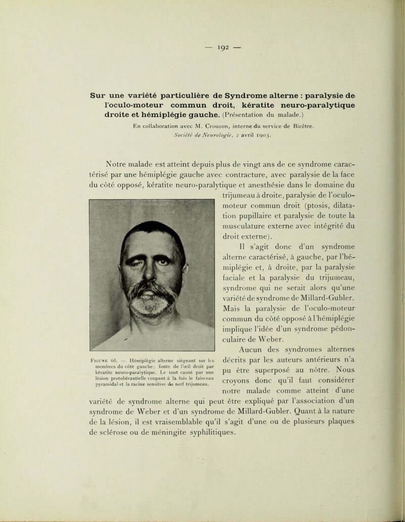 Sur une variété particulière de Syndrome alterne : paralysie de l’oculo-moteur commun droit, kératite neuro-paralytique droite et hémiplégie gauche. (Présentation du malade.) En collaboration avec M. Crouzon, interne du service de Bicêtre. Société de Neurologie, 2 avril 1903. Notre malade est atteint depuis plus de vingt ans de ce syndrome carac- térisé par une hémiplégie gauche avec contracture, avec paralysie de la face du côté opposé, kératite neuro-paralytique et anesthésie dans le domaine du trijumeau à droite, paralysie de l’oculo- moteur commun droit (ptosis, dilata- tion pupillaire et paralysie de toute la musculature externe avec intégrité du droit externe). 11 s’agit donc d’un syndrome alterne caractérisé, à gauche, par l’hé- miplégie et, à droite, par la paralysie faciale et la paralysie du trijumeau, syndrome qui ne serait alors qu’une variété de syndrome de Millard-Gubler. Mais la paralysie de l’oculo-moteur commun du côté opposé à l'hémiplégie implique l’idée d’un syndrome pédon- culaire de Weber. Aucun des syndromes alternes décrits par les auteurs antérieurs n’a pu être superposé au nôtre. Nous croyons donc qu’il faut considérer notre malade comme atteint d’une variété de syndrome alterne qui peut être expliqué par l’association d’un syndrome de Weber et d’un syndrome de Millard-Gubler. Quant à la nature de la lésion, il est vraisemblable qu’il s’agit d’une ou de plusieurs plaques de sclérose ou de méningite syphilitiques. Figure 66. — Hémiplég-ie alterne siég^eant sur les membres du côté g'auche ; fonte de l’œil droit par kératite neuro-paralytique. Le tout causé par une lésion protubérantielle coupant à la fois le faisceau pyramidal et la racine sensitive du nerf trijumeau.