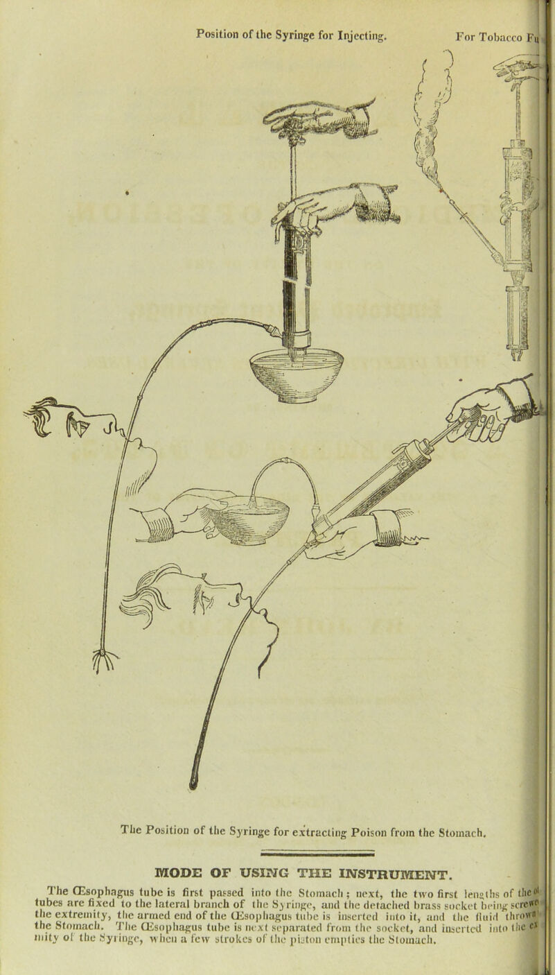 The Position of the Syringe for extracting Poison from the Stomach, MODE OF USING THE INSTRUMENT. The CEsophagns tube is first passed into (he Stomacli; next, tlie two first lenglhs of the®* tubes are fixed to the lateral branch of the Syringe, and the detached brass socket being screfff| the extremity, the armed end of the (Esophagus tube is inserted into it, and the (luid thro® the Stomach. The Oesophagus tube is next separated from the socket, and inserted into llie inity ol the Syringe, when a few strokes of tlie i)istou empties the Stomach.