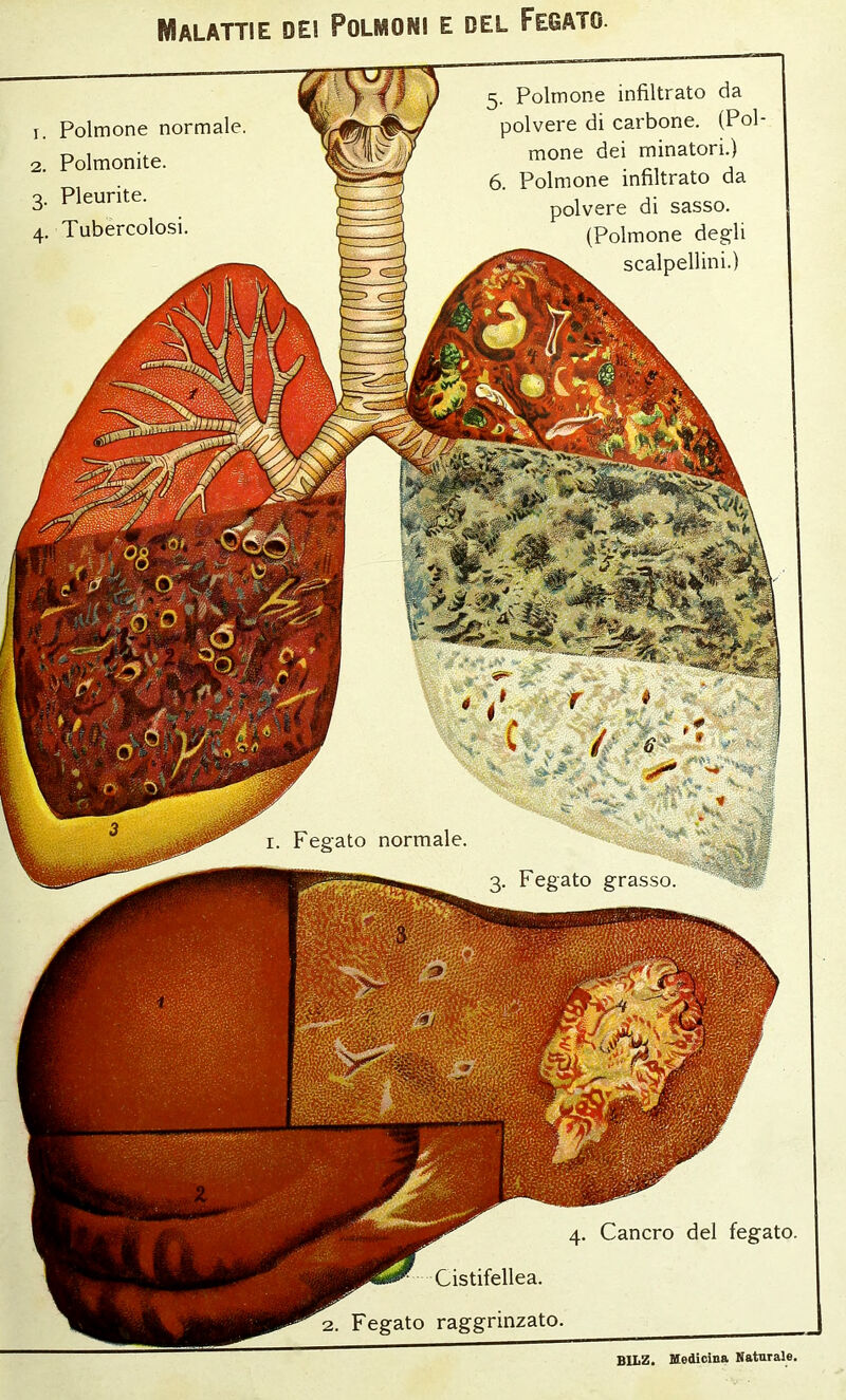 Malattie dei Polmoni e del Fegato. BILZ. Medicina Naturale. 4. Cancro del fegato. Cistifellea. 2. Fegato raggrinzato. 1. Polmone normale. 2. Polmonite. 3. Pleurite. 4. Tubercolosi. 5. Polmone infiltrato da polvere di carbone. (Pol- mone dei minatori.) 6. Polmone infiltrato da polvere di sasso. (Polmone degli scalpellini.)