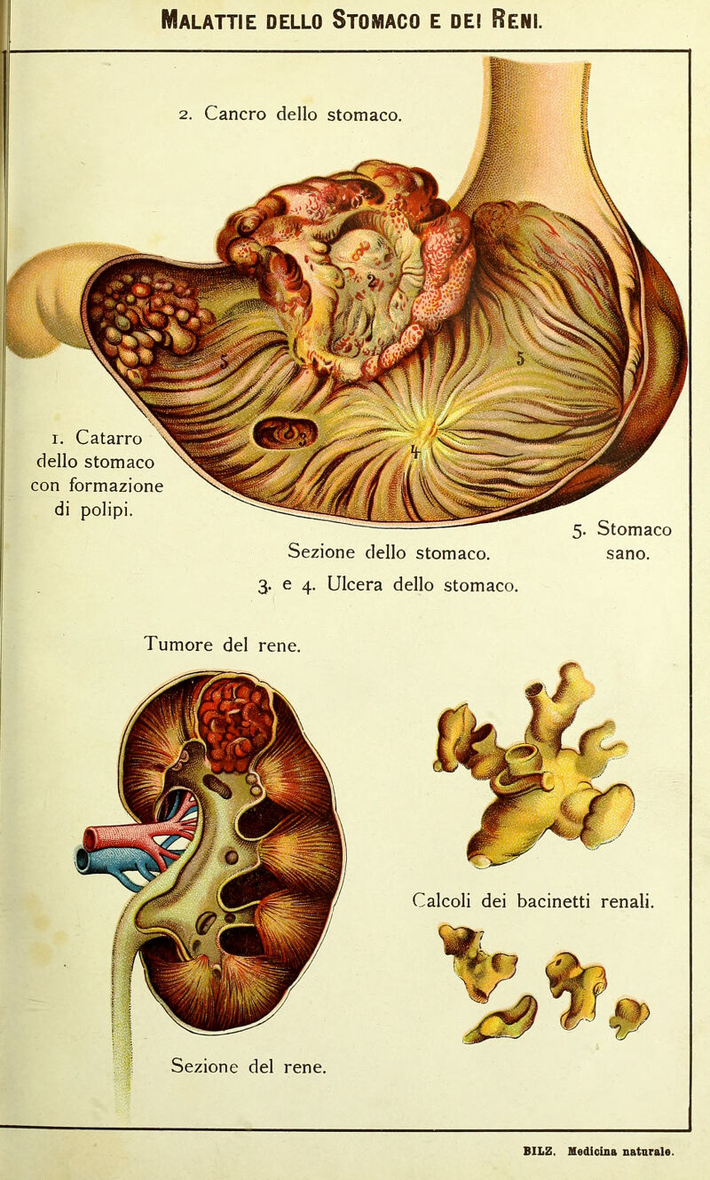Malattie dello Stomaco e dei Reni. 2. Cancro dello stomaco. Sezione dello stomaco. 3. e 4. Ulcera dello stomaco. 5. Stomaco sano. 1. Catarro dello stomaco con formazione di polipi. Tumore del rene. Sezione del rene. Calcoli dei bacinetti renali.