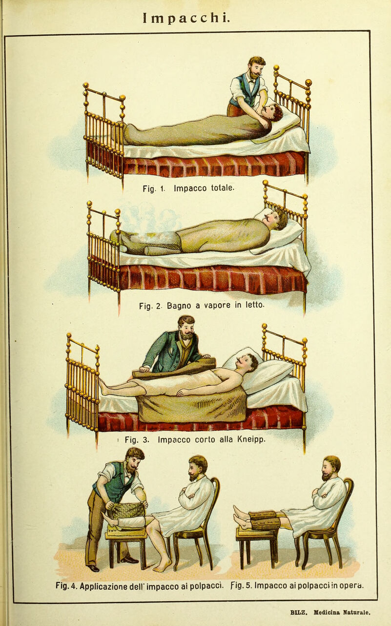 Impacchi. Fig. 1. Impacco totale Fig. 2 Bagno a vapore in letto i Fig. 3. Impacco corto alla Kneipp, Fig. 4. Applicazione dell' impacco ai polpacci, fig. 5. Impacco ai polpacci in opera.