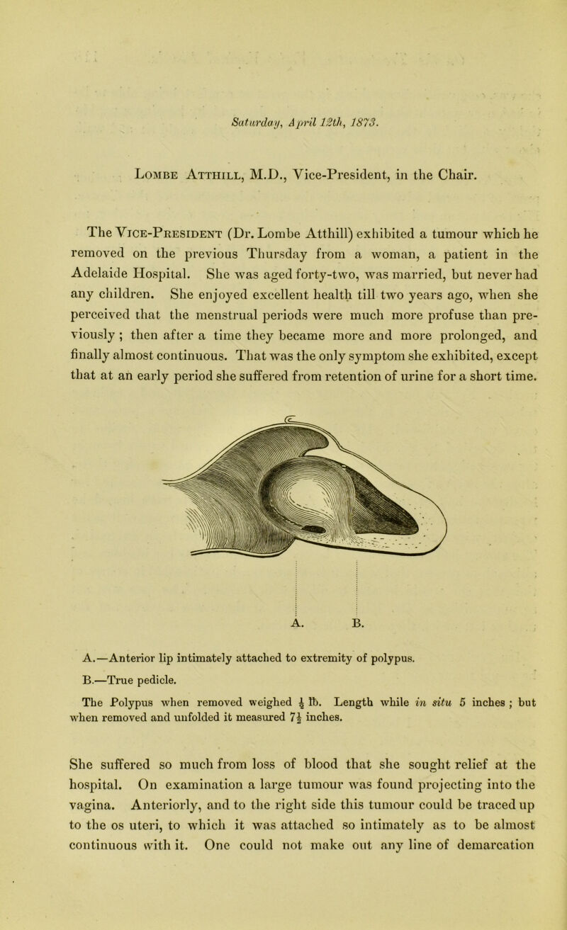 Saturday, April 12th, 1873. Lombe Atthill, M.D., Vice-President, in the Chair. The Vice-President (Dr. Lombe Atthill) exhibited a tumour which he removed on the previous Thursday from a woman, a patient in the Adelaide Hospital. She was aged forty-two, was married, but never had any children. She enjoyed excellent health till two years ago, when she perceived that the menstrual periods were much more profuse than pre- viously ; then after a time they became more and more prolonged, and finally almost continuous. That was the only symptom she exhibited, except that at an early period she suffered from retention of urine for a short time. A. B. A. —Anterior lip intimately attached to extremity of polypus. B. —True pedicle. The Polypus when removed weighed A R>. Length while in situ 5 inches ; but when removed and unfolded it measured 7| inches. She suffered so much from loss of blood that she sought relief at the hospital. On examination a large tumour was found projecting into the vagina. Anteriorly, and to the right side this tumour could be traced up to the os uteri, to which it was attached so intimately as to be almost continuous with it. One could not make out any line of demarcation