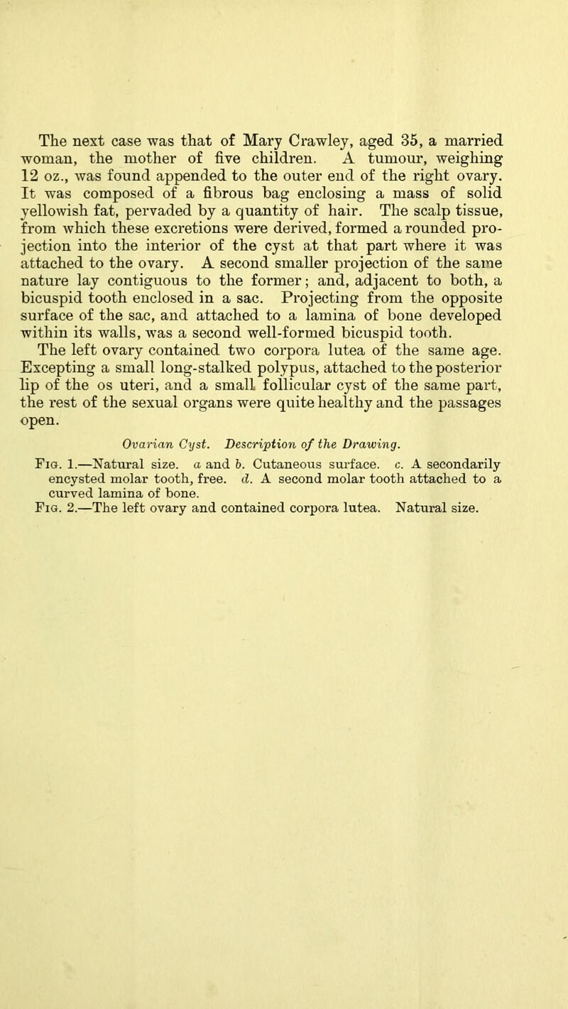 The next case was that of Mary Crawley, aged 35, a married woman, the mother of five children. A tumour, weighing 12 oz., was found appended to the outer end of the right ovary. It was composed of a fibrous bag enclosing a mass of solid yellowish fat, pervaded by a quantity of hair. The scalp tissue, from which these excretions were derived, formed a rounded pro- jection into the interior of the cyst at that part where it was attached to the ovary. A second smaller projection of the same nature lay contiguous to the former; and, adjacent to both, a bicuspid tooth enclosed in a sac. Projecting from the opposite surface of the sac, and attached to a lamina of bone developed within its walls, was a second well-formed bicuspid tooth. The left ovary contained two corpora lutea of the same age. Excepting a small long-stalked polypus, attached to the posterior lip of the os uteri, and a small follicular cyst of the same part, the rest of the sexual organs were quite healthy and the passages open. Ovarian Cyst. Description of the Drawing. Fig. 1.—Natural size, a and b. Cutaneous surface, c. A secondarily encysted molar tooth, free. d. A second molar tooth attached to a curved lamina of bone. Fig. 2.—The left ovary and contained corpora lutea. Natural size.