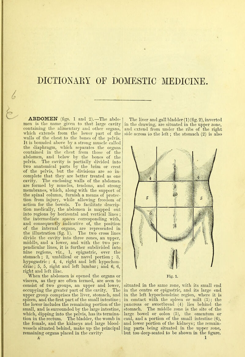 DICTIONARY OF DOMESTIC MEDICINE ABDOMEN (figs. 1 and 2).—Tlie abdo- men i.s tlio name given to that largo cavity containing the alimentary and other organs, vhich extends from the lower jiart of the walls of the chest to the liones of the pelvis. It is bounded above bj- a strong muscle called the diaphragm, which separates the oigans contained in the chest irom tho.se of the abdomen, and below by the bones of the pelvis. The cavity is partially divided into two anatomical parts by the brim or crest of the pelvis, but the divisions are so in- complete that they are better treated as one cavity. The enclosing walls of the abdomen are formed by muscles, tendons, and strong membranes, which, along with the support of the spinal column, furnish a means of protec- tion from injury, while allowing freedom of action for the bowels. To facilitate descrij)- tion medically, the abdomen is mapped out into regions by horizontal and vertical lines ; the intermediate spaces corresponding with, and consequently indicative of, the X’osition of the internal organs, are represented in the illustration (fig. 1). The two cross lines divide the cavity into three zones, an ujqier, middle, and a lower, and with the two j^er- pendicular lines, it is further subdivided into nine regions, viz., 1, epigastric, over the stomach ; 2, umbilical or navel x»rtion ; 3, hypogasti’ic ; 4, 4, right and left hy^jochon- driac; 5, 5, right and left lumbar; and 6, 6, right and loft iliac. When the abdomen is ojiened the organs or viscera, as they are often termed, are seen to consist of two groups, an uj^per and lower, occupiying the greater j)art of the cavity. The upjier grouj) comprises the liver, stomach, and sjjleen, and the first part of the small intestine ; the lower includes the remaining xwrtion of the small, and is surrounded by the large intestine, which, dixqiing into the jjelvis, has its termina- tion in the rectum. The bladder, the womb in the female, and the kidneys and large blood- vessels situated behind, make uxi the principal remaining organs xfiaced in the cavity The liver and gall bladder (1) (fig. 2), inverted in the drawing, are situated in the upper zone, and extend from under the ribs of the right side across to the left; the stomach (2) is also Fig. 1. situated in the same zone, with its small end in the centre or epigastric, and its large end in the left hypochondriac region, where it is in contact with the sificen or milt (3); the }>ancreas or sweetbread (4) lies behind the stomach. The middle zone is the site of the large bowel or colon (5), the omentum or caul, and a jrortion of the small intestine (6), and lower portion of the kidneys; the remain- ing piarts being situated in the uxiper zone, but too deex)-seated to be shoum in the figure.