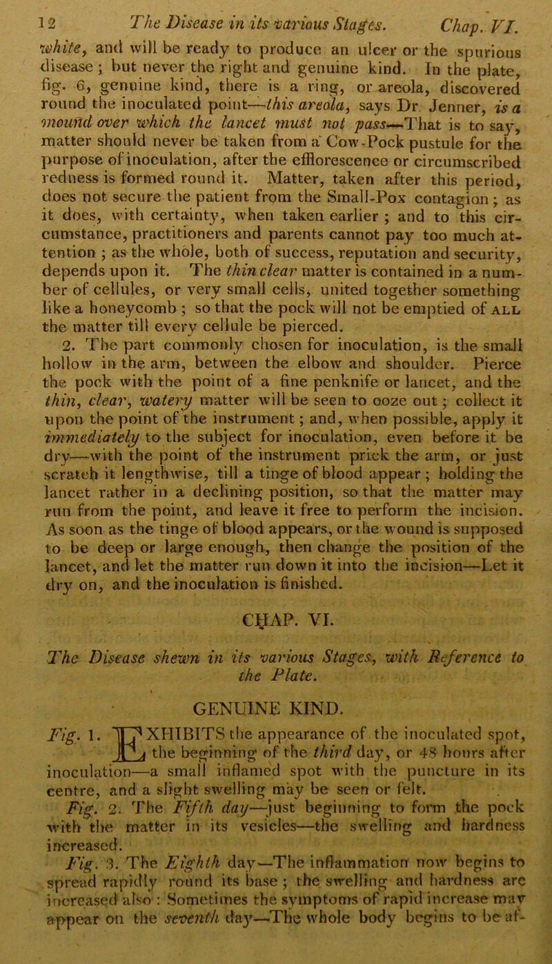 whitey and will be ready to produce an ulcer or the spurious disease ; but never the right and genuine kind. In the plate, fig. 6, genuine kind, there is a ring, or areola, discovered round the inoculated this areolay says Dr. Jenner, is a mouiid over which the lancet must not pass—.T\\z.t is to say, matter should never be taken from a Cow-Pock pustule for the purpose of inoculation, after the efflorescence or circumscribed redness is formed round it. Matter, taken after this period, does not secure the patient from the Small-Pox contagion ; as it does, with certainty, when taken earlier ; and to this cir- cumstance, practitioners and parents cannot pay too much at- tention ; as the whole, both of success, reputation and security, depends upon it. The thin clear matter is contained in a num- ber of cellules, or very small cells, united together something like a honeycomb ; so that the pock will not be emptied of all the matter till every cellule be pierced. 2. The part commonly chosen for inoculation, is the small hollow in the arm, between the elbow and shoulder. Pierce the pock with the point of a fine penknife or lancet, and the thbiy cleary watery matter will be seen to ooze out; collect it upon the point of the instrument; and, when possible, apply it immediately to the subject for inoculation, even before it be di-y—with the point of the instrument prick the arm, or just scratch it lengthwise, till a tinge of blood appear ; holding the lancet rather in a declining position, so that the matter may run from the point, and leave it free to perform the incision. As soon as the tinge of blood appears, or the wound is supposed to be deep or large enough, then change the position of the lancet, and let the matter run down it into the incision—Let it dry on, and the inoculation is finished. C^AP. VI. The Disease shewn in its various Stages, with Reference to the Plate. I GENUINE KIND. Fig. 1. ITT'XHIBITS the appearance of the inoculated spot, ]PA the beginning of the third day, or 48 hours after inoculation—a small inflamed spot with the puncture in its centre, and a slight swelling may be seen or felt. Fig. 2. The Fifth day—just beginning to fot*m the pock with the matter in its vesicles—the swelling and hardness increased. Fig. 3. The Eighth day—The inflammation now begins to spread rapidly round its base ; the swelling and hardness are increased also : Sometimes the symptoms of rapid increase may appear oti the sevettth day—The whole body begins to beat-