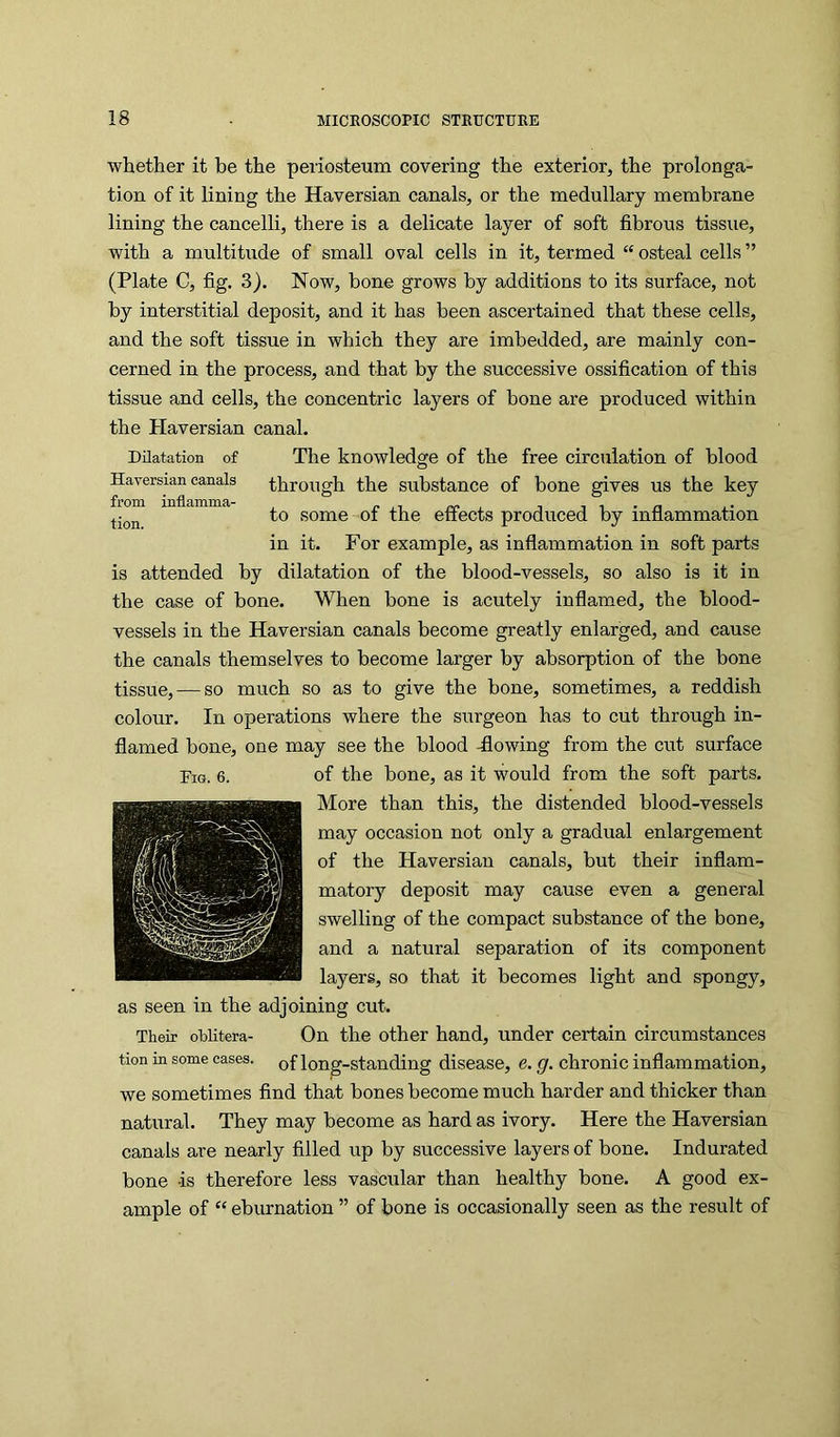 whether it be the periosteum covering the exterior, the prolonga- tion of it lining the Haversian canals, or the medullary membrane lining the cancelli, there is a delicate layer of soft fibrous tissue, with a multitude of small oval cells in it, termed “ osteal cells ” (Plate C, fig. 3). Now, bone grows by additions to its surface, not by interstitial deposit, and it has been ascertained that these cells, and the soft tissue in which they are imbedded, are mainly con- cerned in the process, and that by the successive ossification of this tissue and cells, the concentric layers of bone are produced within the Haversian canal. Dilatation of The knowledge of the free circulation of blood Haversian canals through the substance of bone gives us the key to some of the effects produced by inflammation in it. For example, as inflammation in soft parts is attended by dilatation of the blood-vessels, so also is it in the case of bone. When bone is acutely inflamed, the blood- vessels in the Haversian canals become greatly enlarged, and cause the canals themselves to become larger by absorption of the bone tissue, — so much so as to give the bone, sometimes, a reddish colour. In operations where the surgeon has to cut through in- flamed bone, one may see the blood -flowing from the cut surface Fig. 6. of the bone, as it would from the soft parts. More than this, the distended blood-vessels may occasion not only a gradual enlargement of the Haversian canals, but their inflam- matory deposit may cause even a general swelling of the compact substance of the bone, and a natural separation of its component layers, so that it becomes light and spongy, as seen in the adjoining cut. Their oblitera- On the other hand, under certain circumstances tion m some cases, of lon^-standing disease, e. g. chronic inflammation, we sometimes find that bones become much harder and thicker than natural. They may become as hard as ivory. Here the Haversian canals are nearly filled up by successive layers of bone. Indurated bone is therefore less vascular than healthy bone. A good ex- ample of “ eburnation ” of bone is occasionally seen as the result of