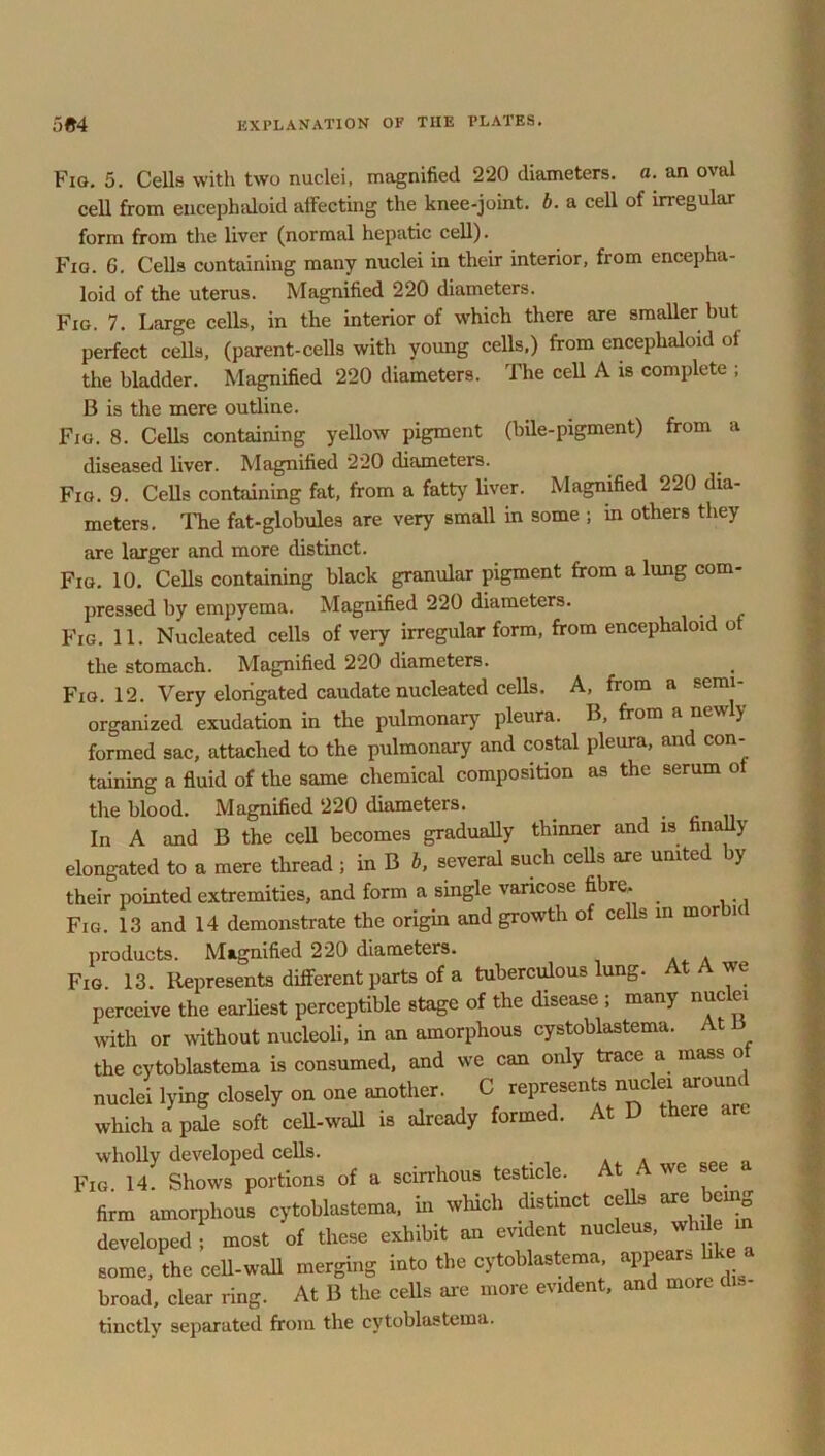 Fig. 5. Cells with two nuclei, magnified 2*20 diameters, a. an oval cell from encephaloid affecting the knee-joint, b. a cell of irregular form from the liver (normal hepatic cell). Fig. 6. Cells containing many nuclei in their interior, from encepha- loid of the uterus. Magnified 220 diameters. Fig. 7. Large cells, in the interior of which there are smaller hut perfect cells, (parent-cells with young cells,) from encephaloid of the bladder. Magnified 220 diameters. The cell A is complete ; B is the mere outline. Fig. 8. Cells containing yellow pigment (bile-pigment) from a diseased liver. Magnified 220 diameters. Fig. 9. Cells containing fat, from a fatty liver. Magnified 220 dia- meters. The fat-globules are very small in some ; in others they are larger and more distinct. Fig. 10. Cells containing black granular pigment from a lung com- pressed by empyema. Magnified 220 diameters. Fig. 11. Nucleated cells of very irregular form, from encephaloid o the stomach. Magnified 220 diameters. Fig. 12. Very elongated caudate nucleated cells. A, from a semi- organized exudation in the pulmonary pleura. B, from a newly formed sac, attacked to the pulmonary and costal pleura, and con- taining a fluid of the same chemical composition as the serum o the blood. Magnified 220 diameters. In A and B the cell becomes gradually thinner and is finally elongated to a mere thread ; in B b, several such cells are united by their pointed extremities, and form a single varicose fibre. Fig. 13 and 14 demonstrate the origin and growth of cells m mor i products. Magnified 220 diameters. . Fig. 13. Represents different parts of a tuberculous lung. At A we perceive the earliest perceptible stage of the disease , many nuc ei with or without nucleoli, in an amorphous cystoblastema. At the cytoblastema is consumed, and we can only trace a mass o nuclei lying closely on one another. C represents nuclei around which a pale soft cell-wall is already formed. At D there are wholly developed cells. Fig. 14. Shows portions of a scirrhous testicle. ' firm amorphous cytoblastema. in which distinct cells arc bcmg developed ; most of these exhibit an evident nucleus, whde m some, the cell-wall merging into the cytoblastema appears blw a broad, clear ring. At B the cells are more evident, and more d - tinctly separated from the cytoblastema.